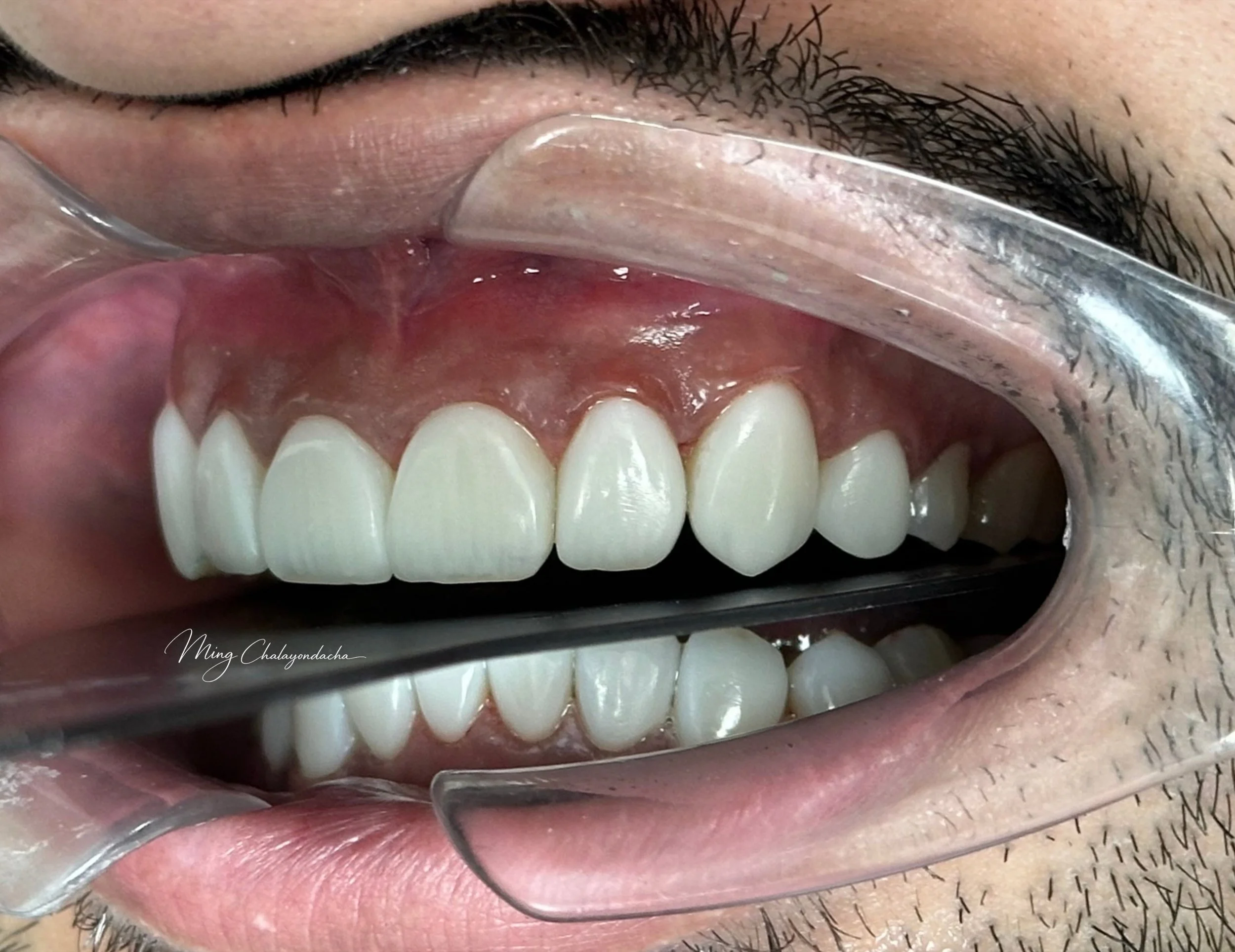 Close-up of a person's open mouth with dental braces on upper teeth, a metal dental tool in use, and the person's lips parted to show the teeth and gums.