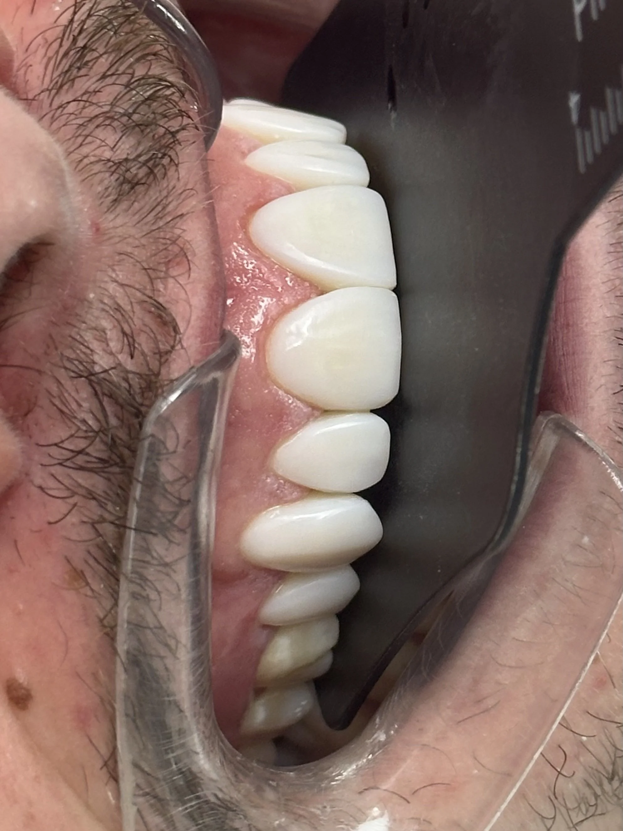 Close-up of a person's mouth with teeth, gums, and surrounding skin visible. The person is wearing glasses and has facial hair.