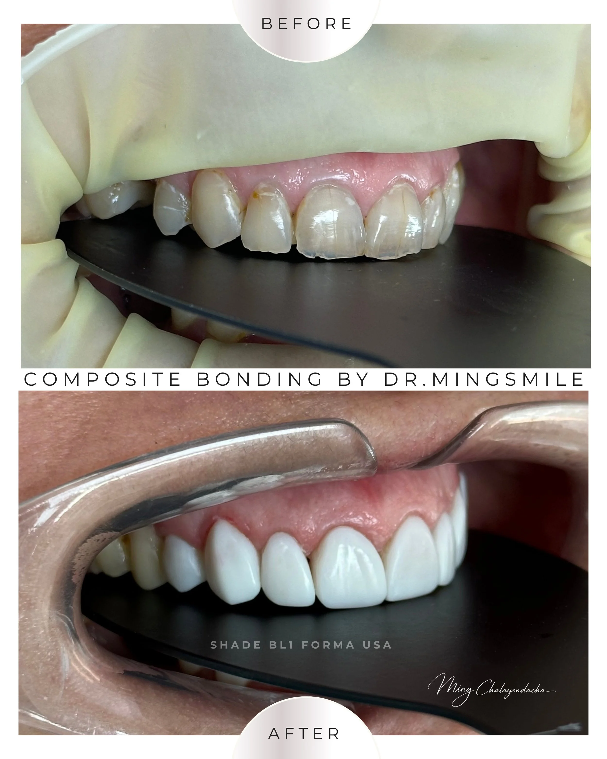 composite bonding  thailand bangkok krabi