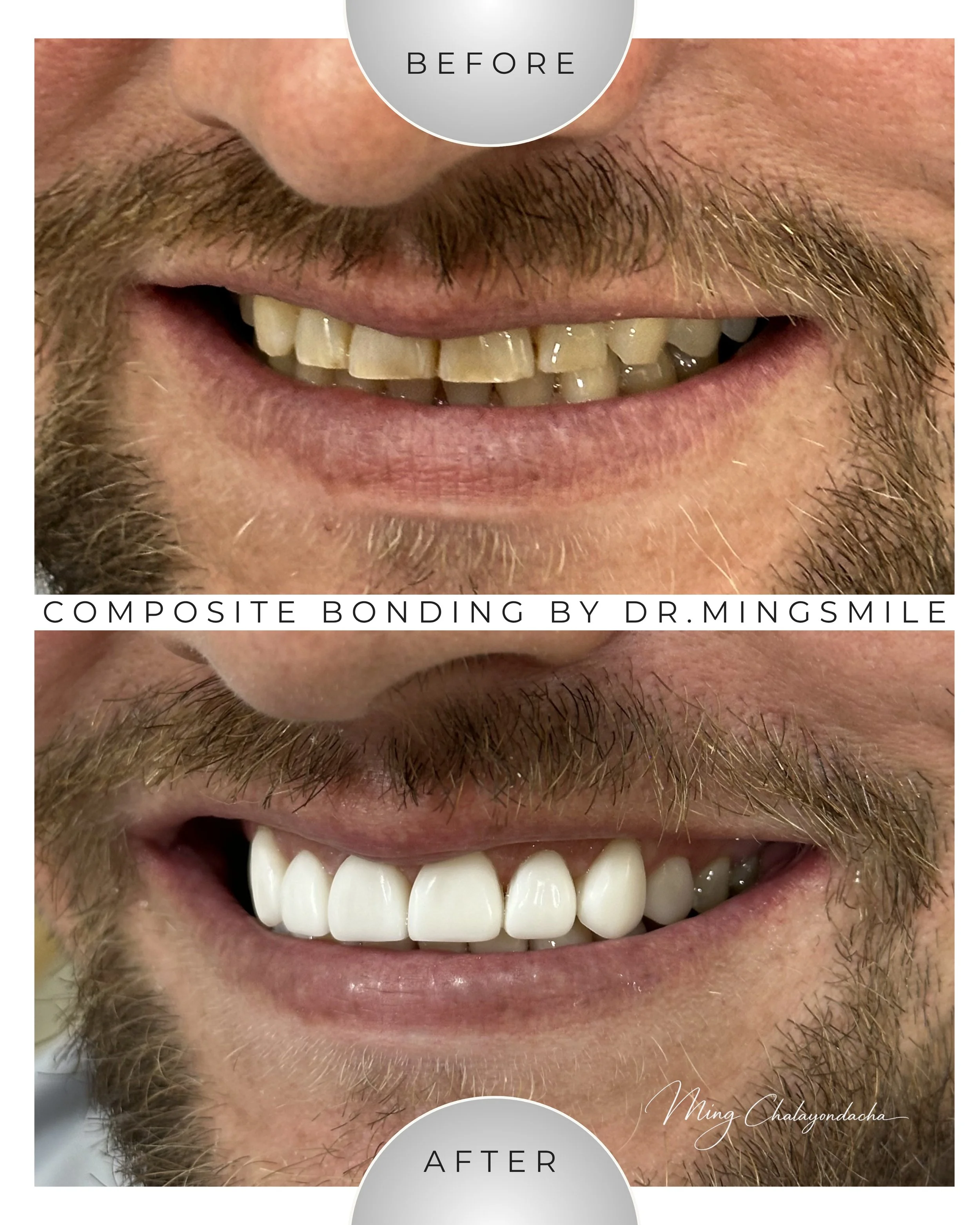 Close-up of a person's mouth before and after cosmetic dental work, showing improved white teeth after treatment.