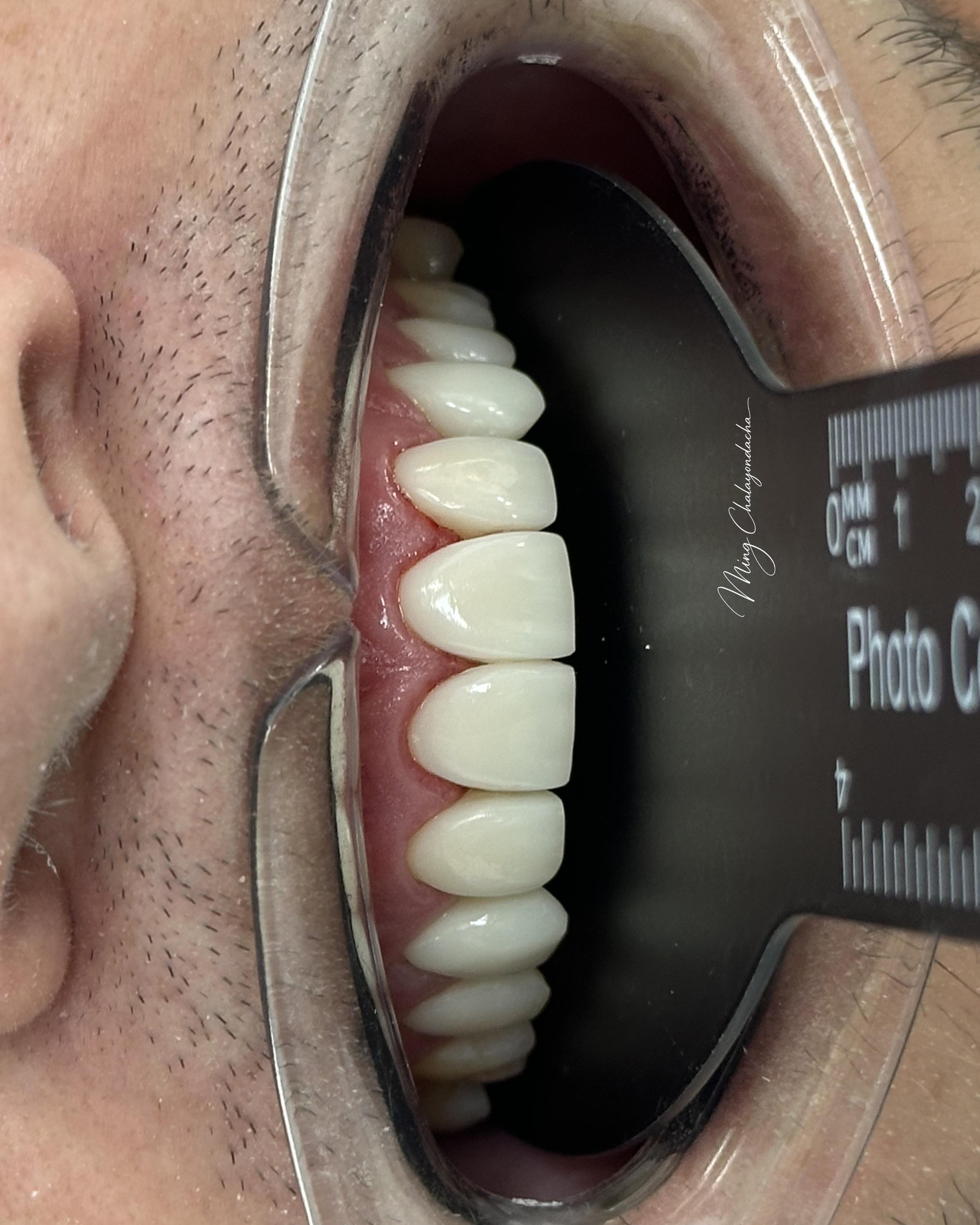 Close-up of human teeth and gums inside a person's open mouth, with dental mirror and dental tools visible at the bottom of the image.