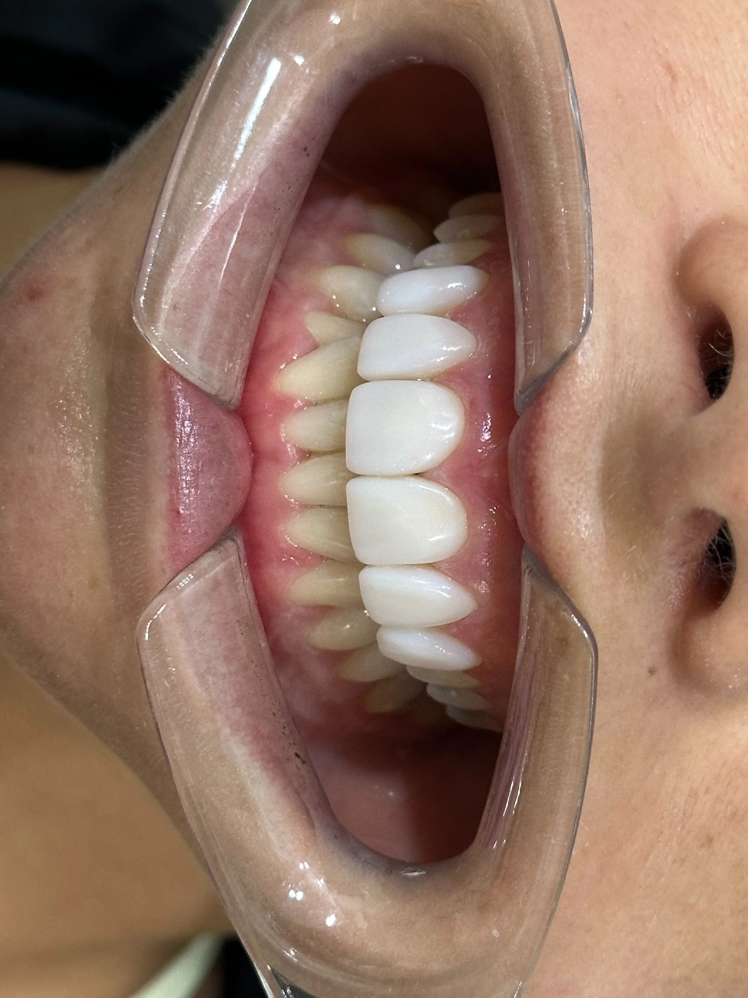 Close-up of a person's mouth with a dental cheek retractor showing the upper row of teeth and gums.