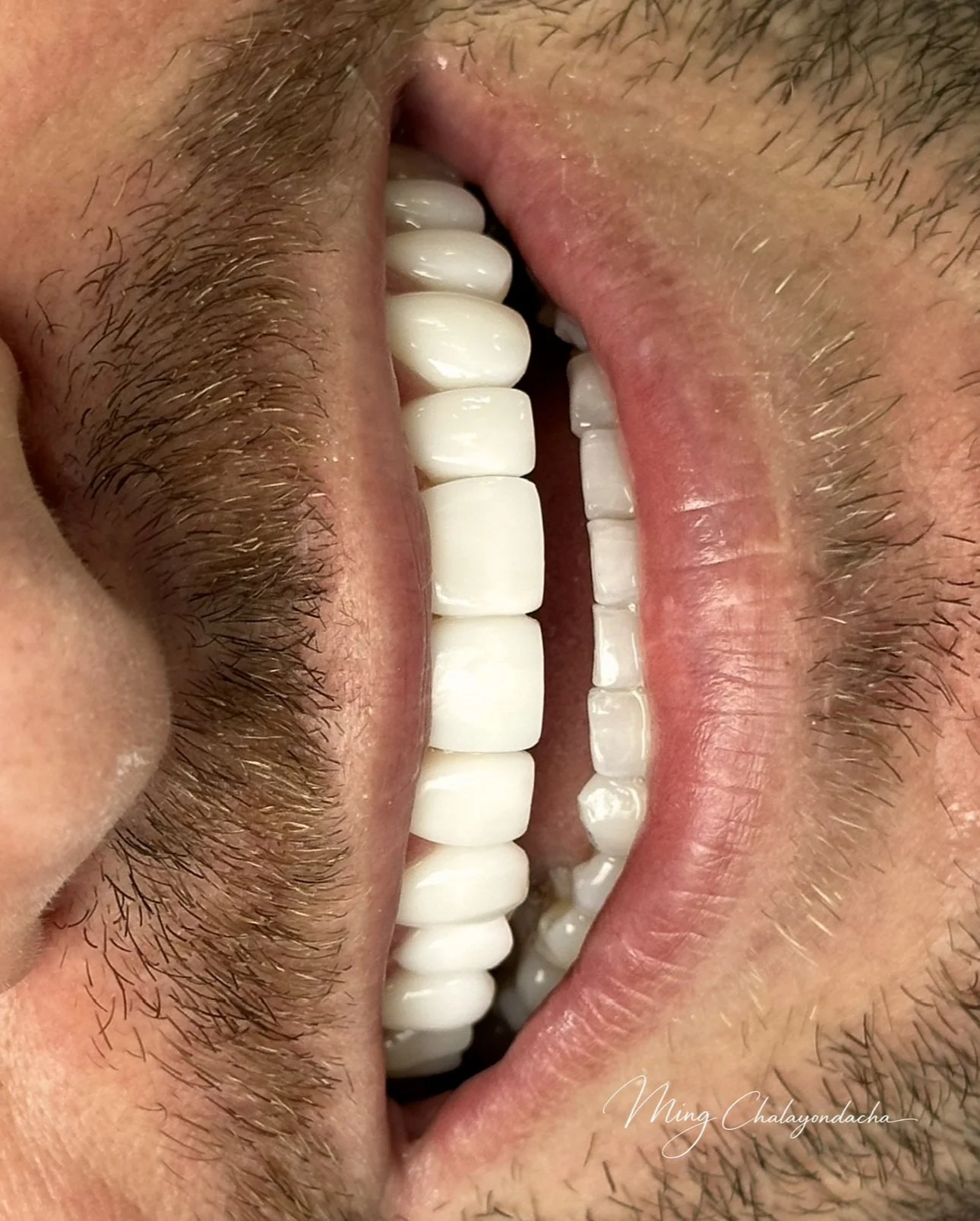 Close-up of a man's open mouth showing white teeth, gums, and facial hair.