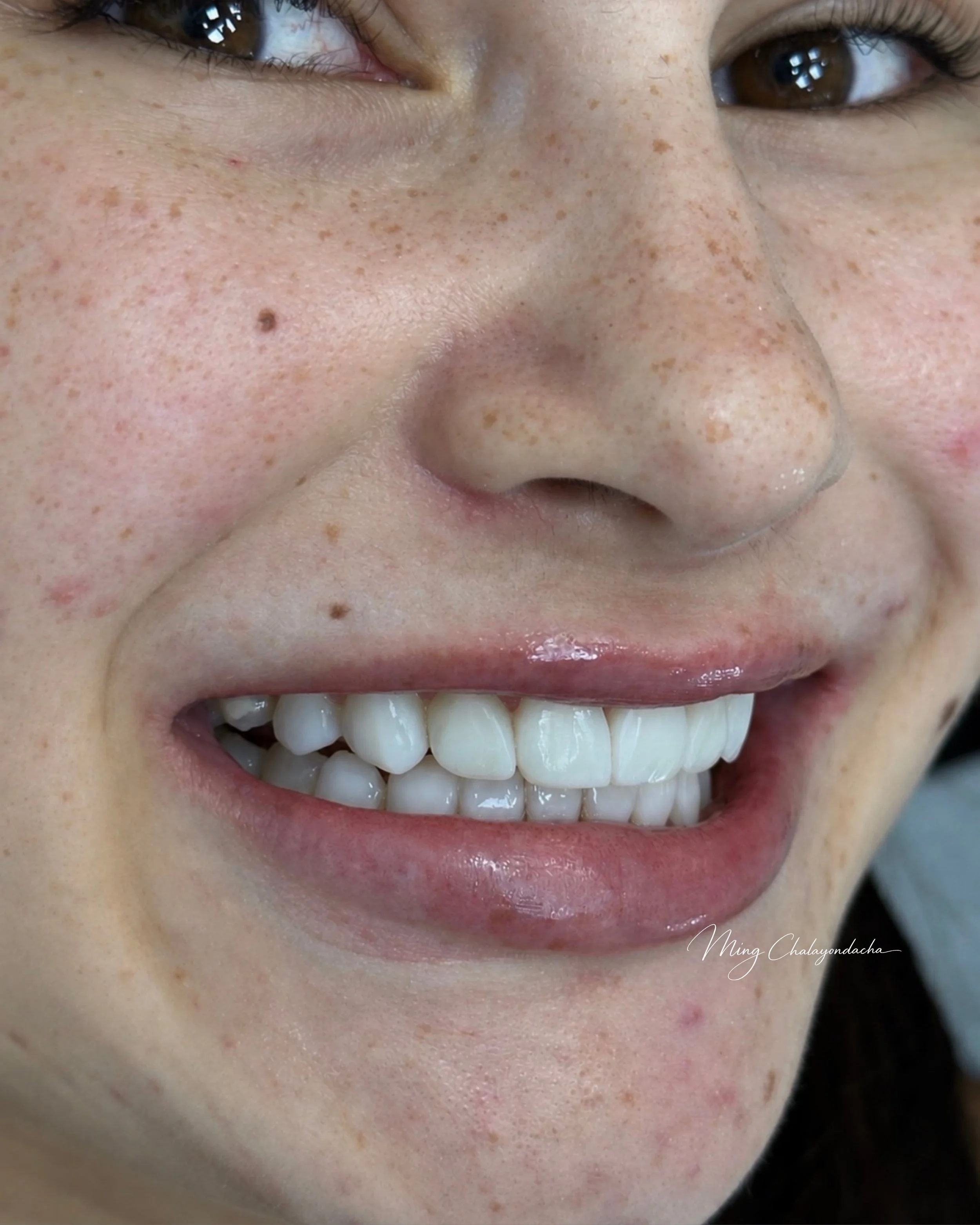 Close-up of a smiling person's face showing their eyes, nose, and mouth, with visible freckles and teeth.