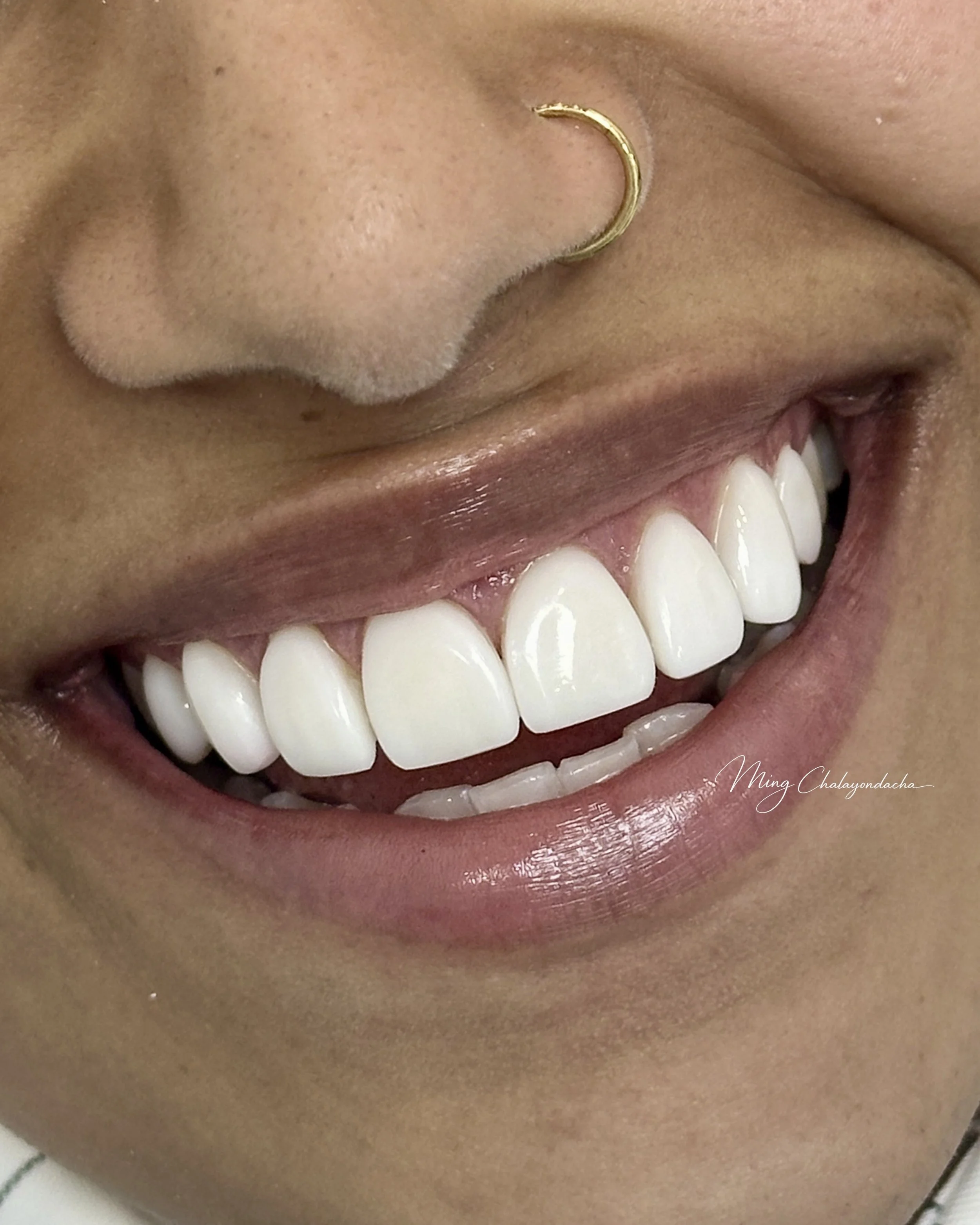 Close-up of a smiling person's mouth showing white teeth, with a gold nose ring in the left nostril.