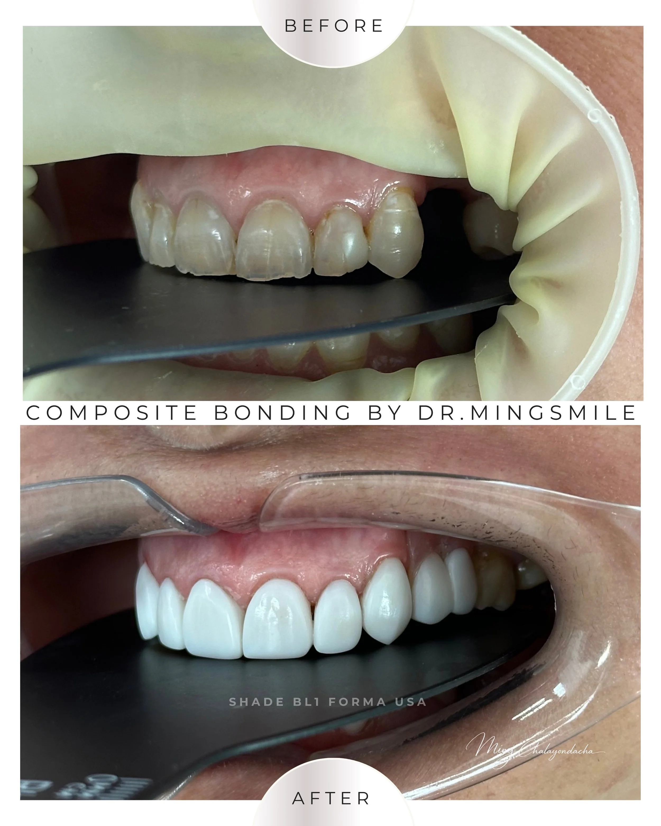 composite bonding  thailand bangkok krabi