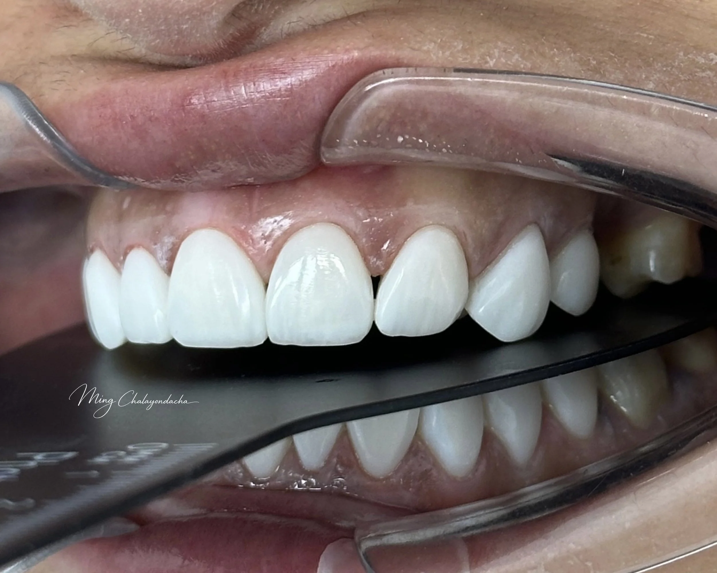 composite bonding  thailand bangkok krabi