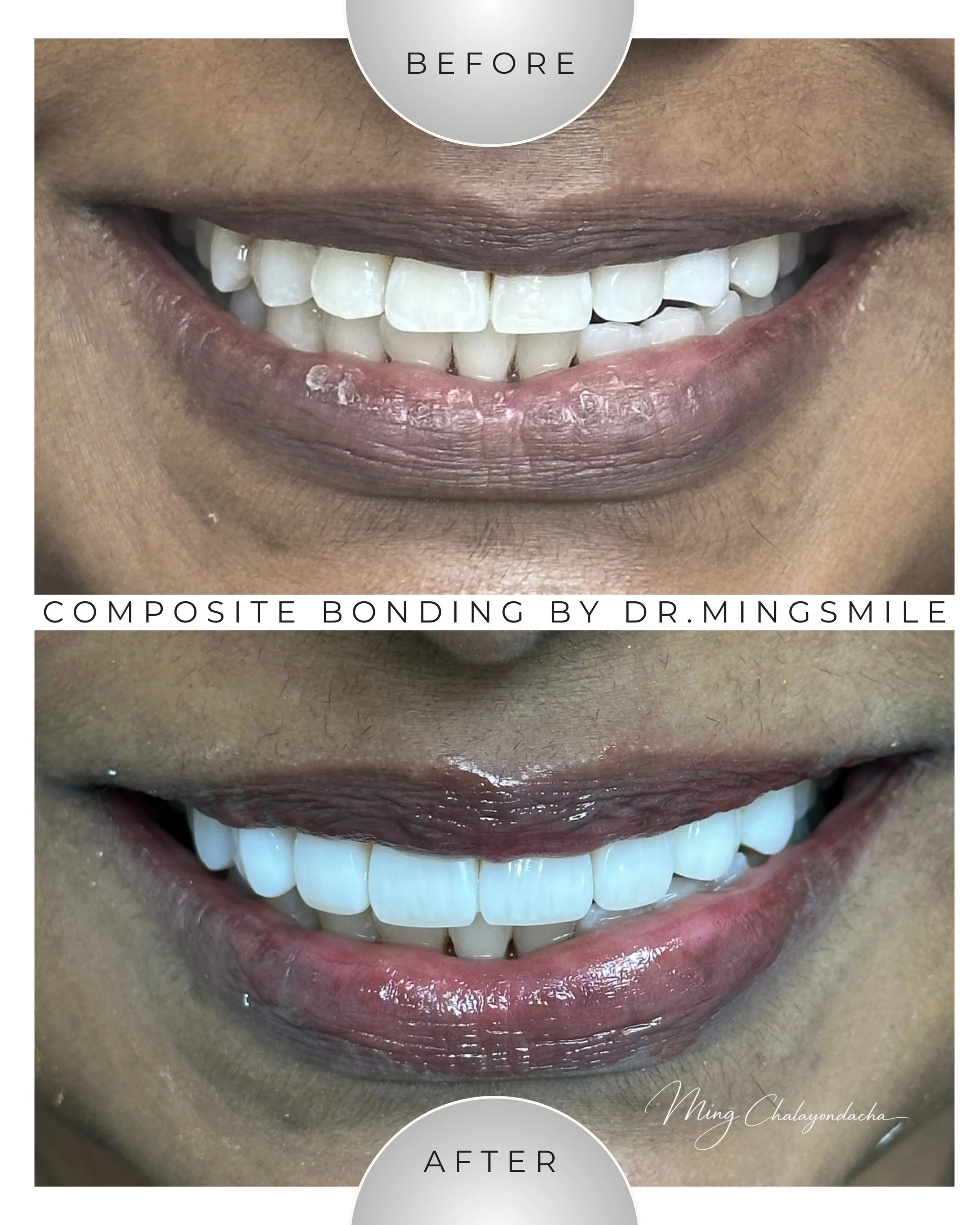 Side-by-side comparison of a person's smile before and after composite bonding, showing whiter and more aligned teeth.