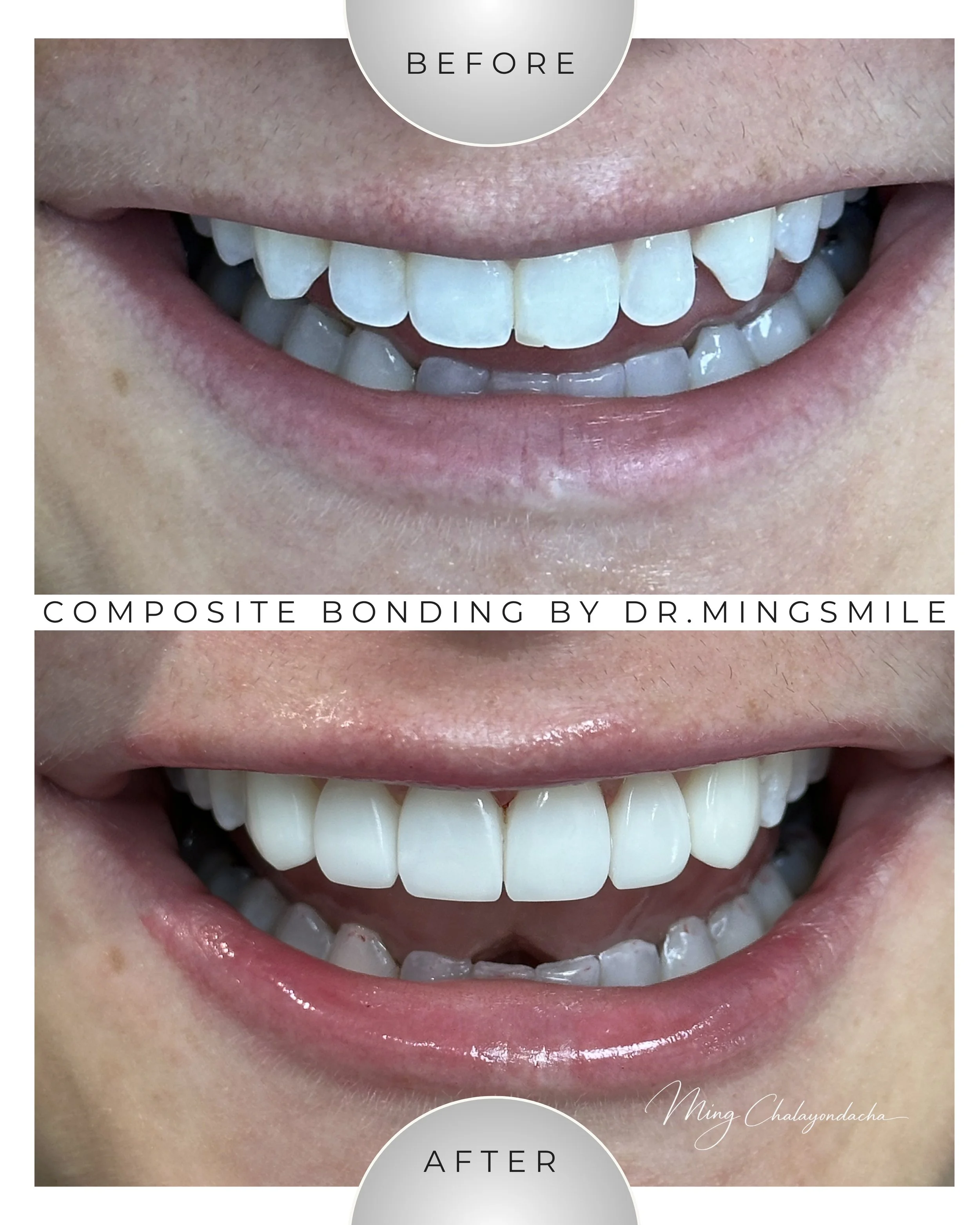 Close-up of a person's smile showing teeth before and after dental composite bonding treatment, with the upper teeth appearing whiter and more aligned in the after image.