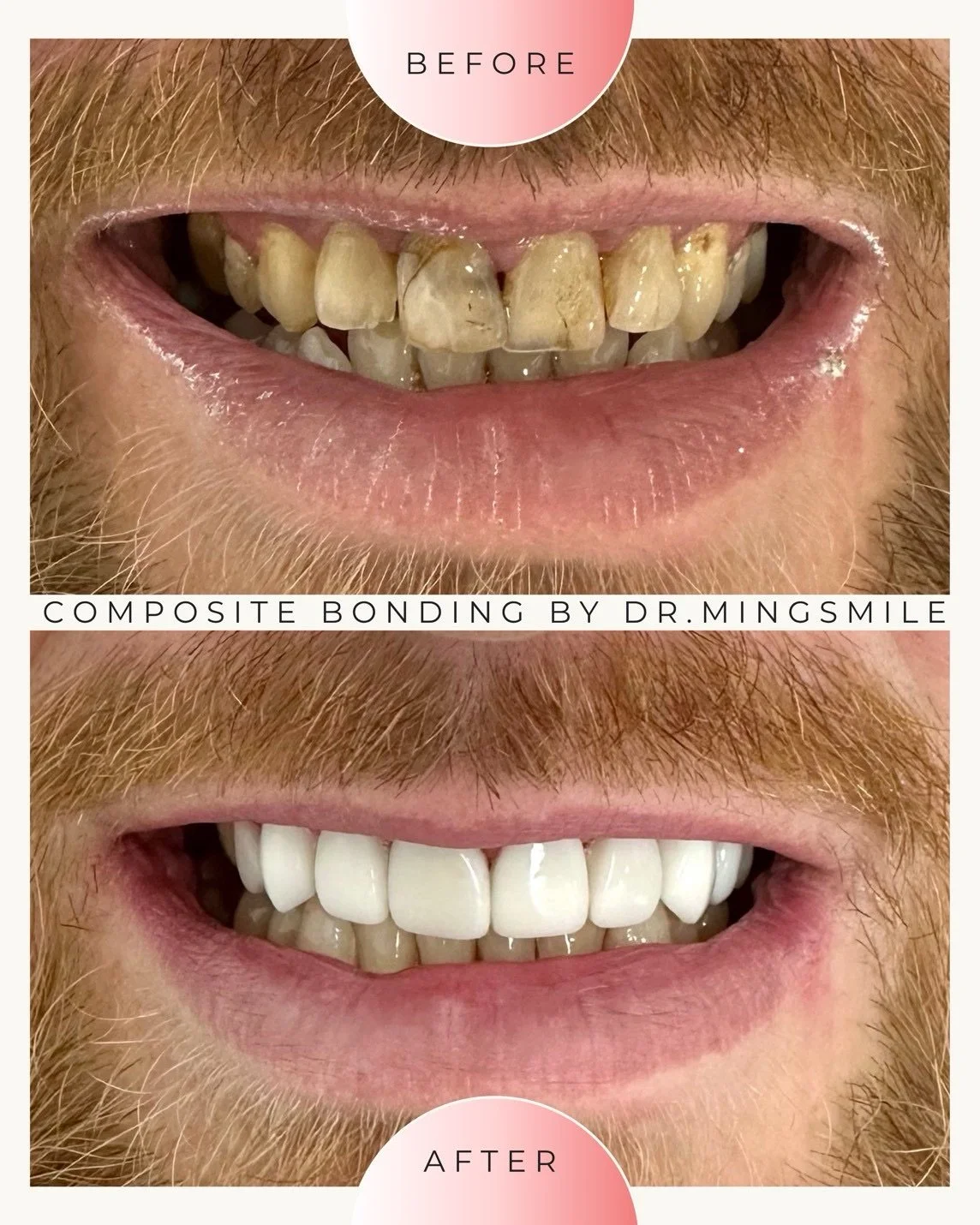 Before and after images of a person's teeth showing dental rehabilitation with composite bonding by Dr. Mingsmile, with improved appearance and whiteness.