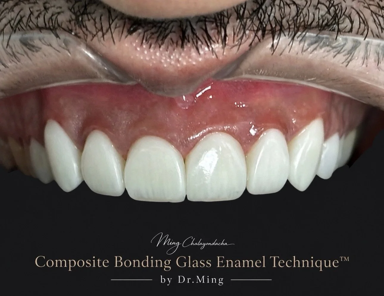 Close-up of a person's upper teeth and gums with dental work, with text overlay mentioning 'Composite Bonding Glass Enamel Technique' by Dr. Ming.