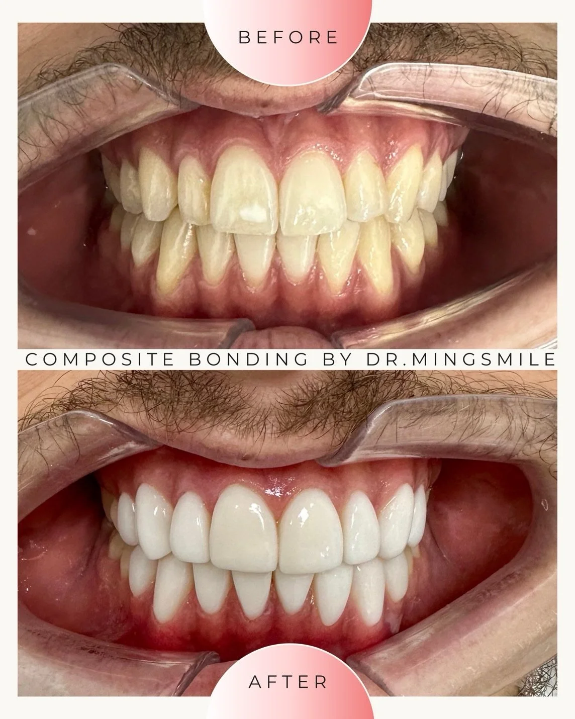 Comparison of teeth before and after composite bonding procedure performed by Dr. Mingsmile, showing improved alignment and whiter appearance.