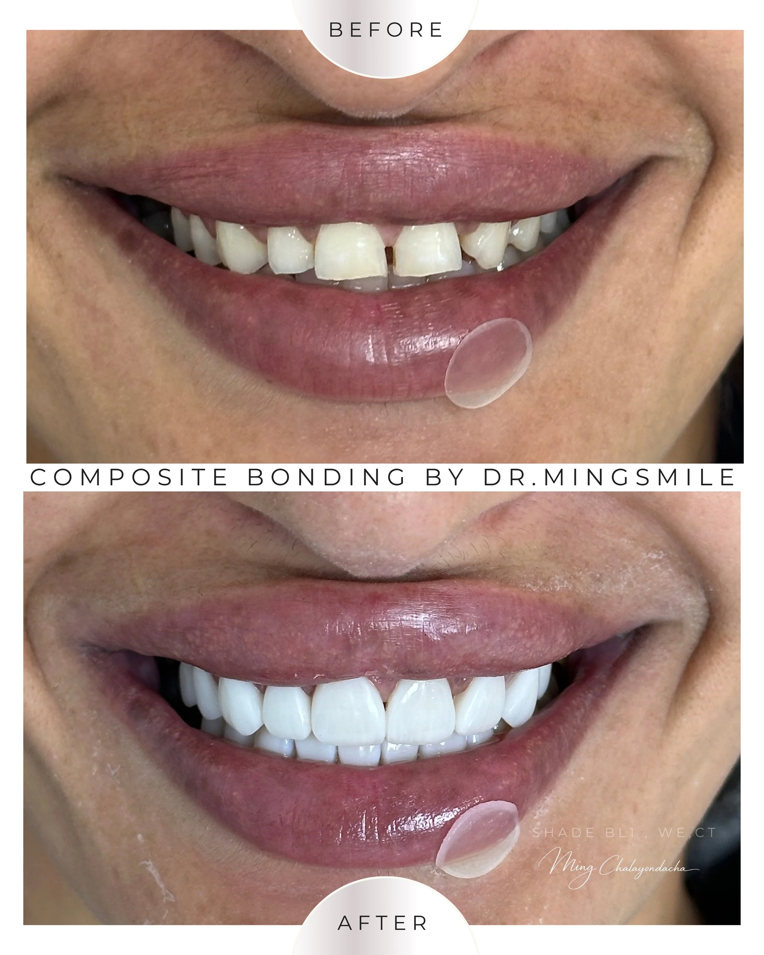 Close-up of a person's smile showing white, evenly shaped teeth before and after dental composite bonding.