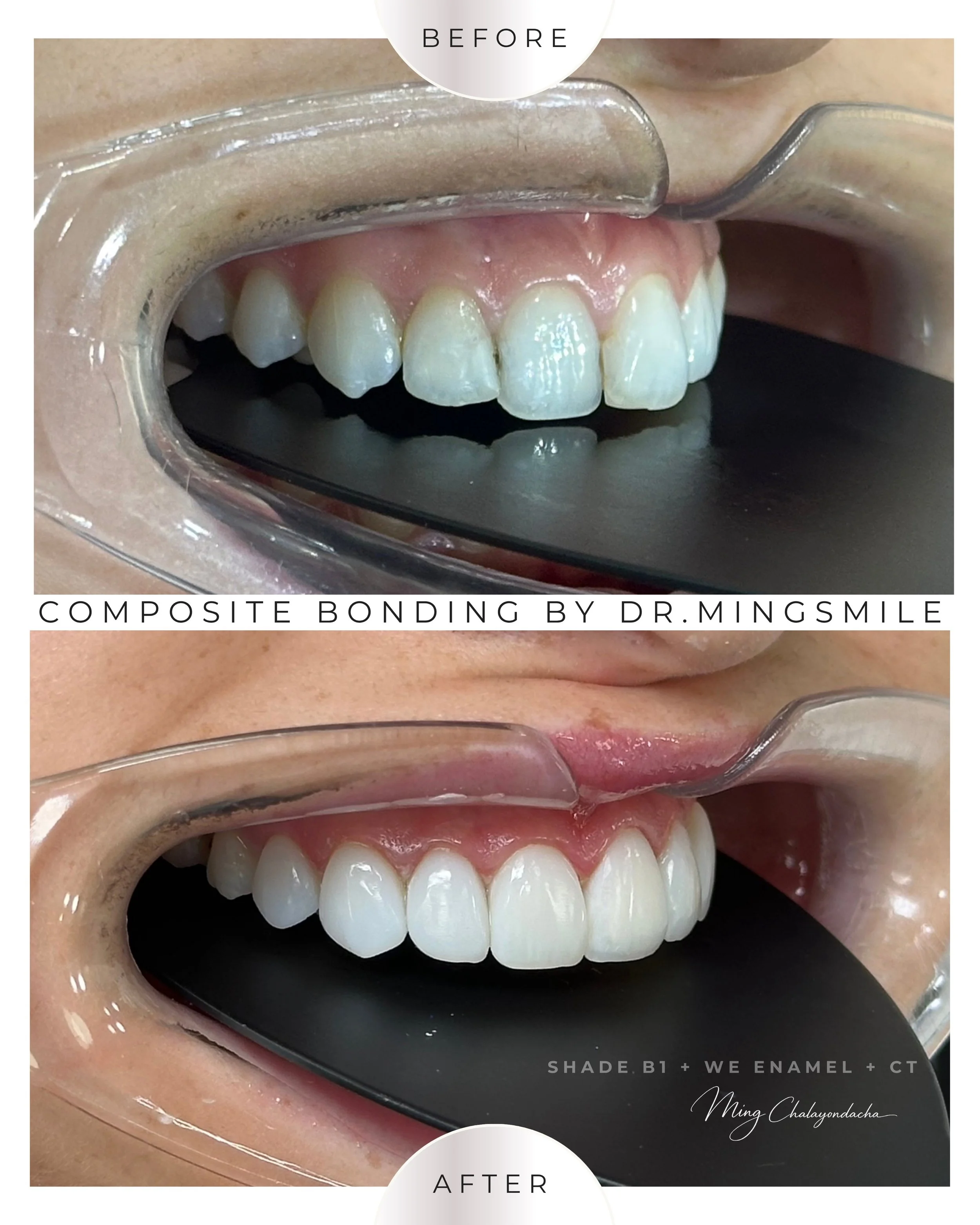 composite bonding  thailand bangkok krabi