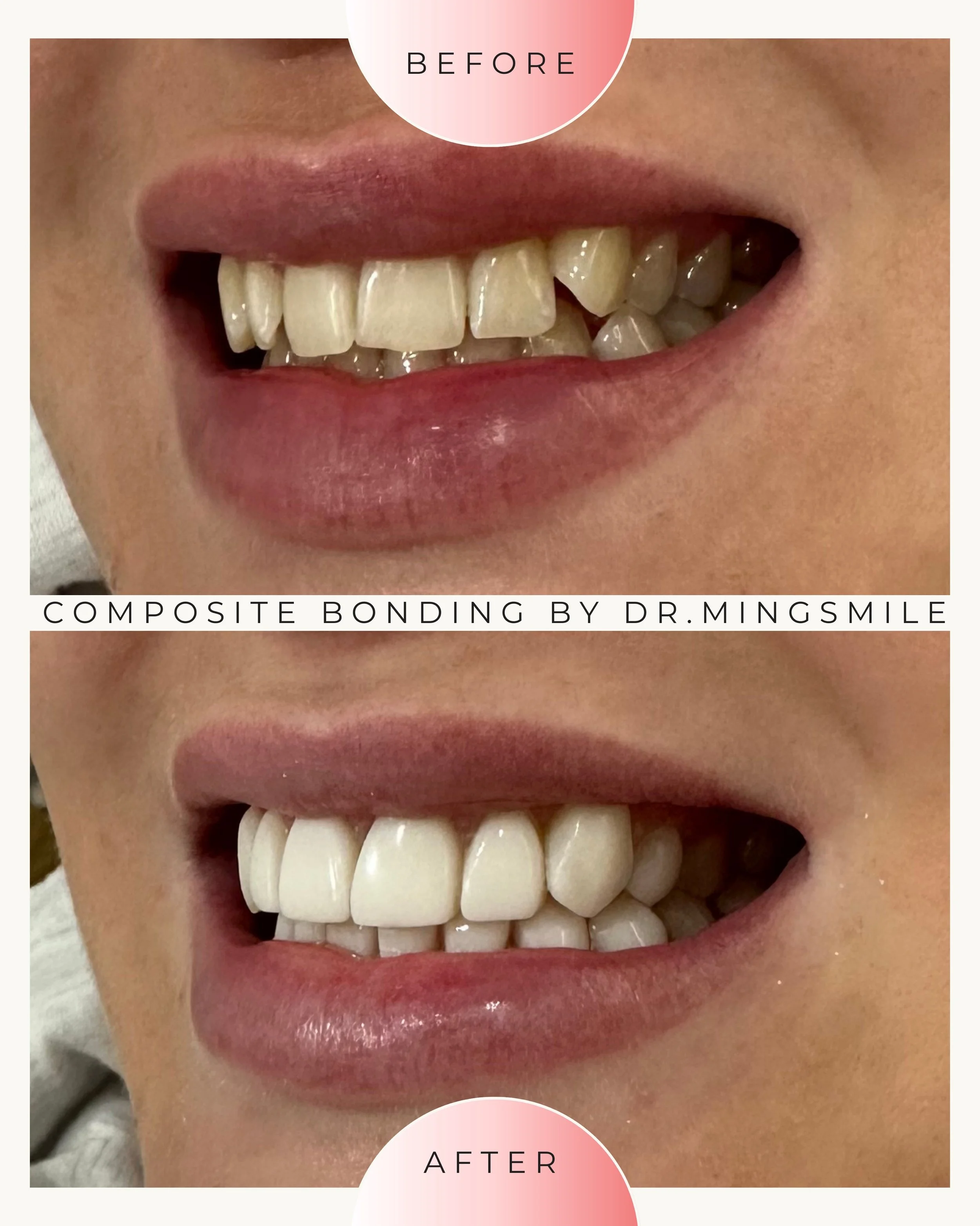 Close-up of a person's smile showing teeth before and after composite bonding, with the before image at the top and the after image at the bottom.