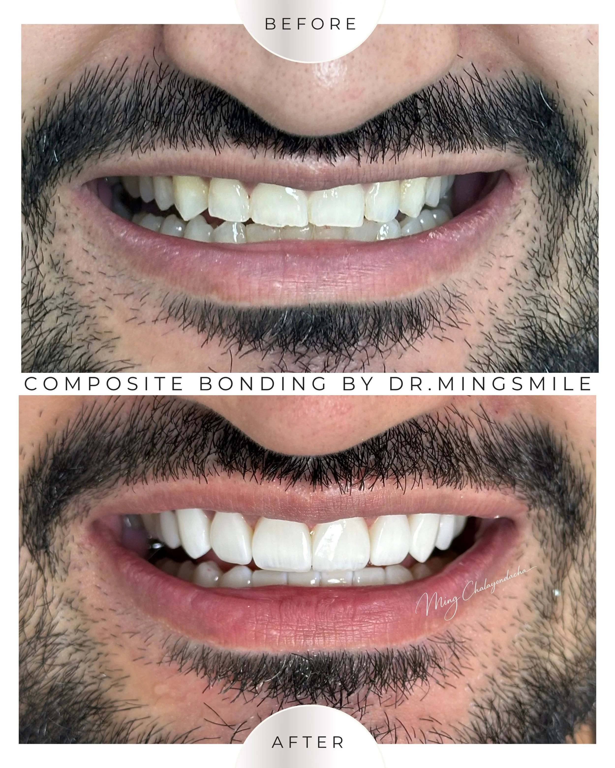 composite bonding  thailand bangkok krabi