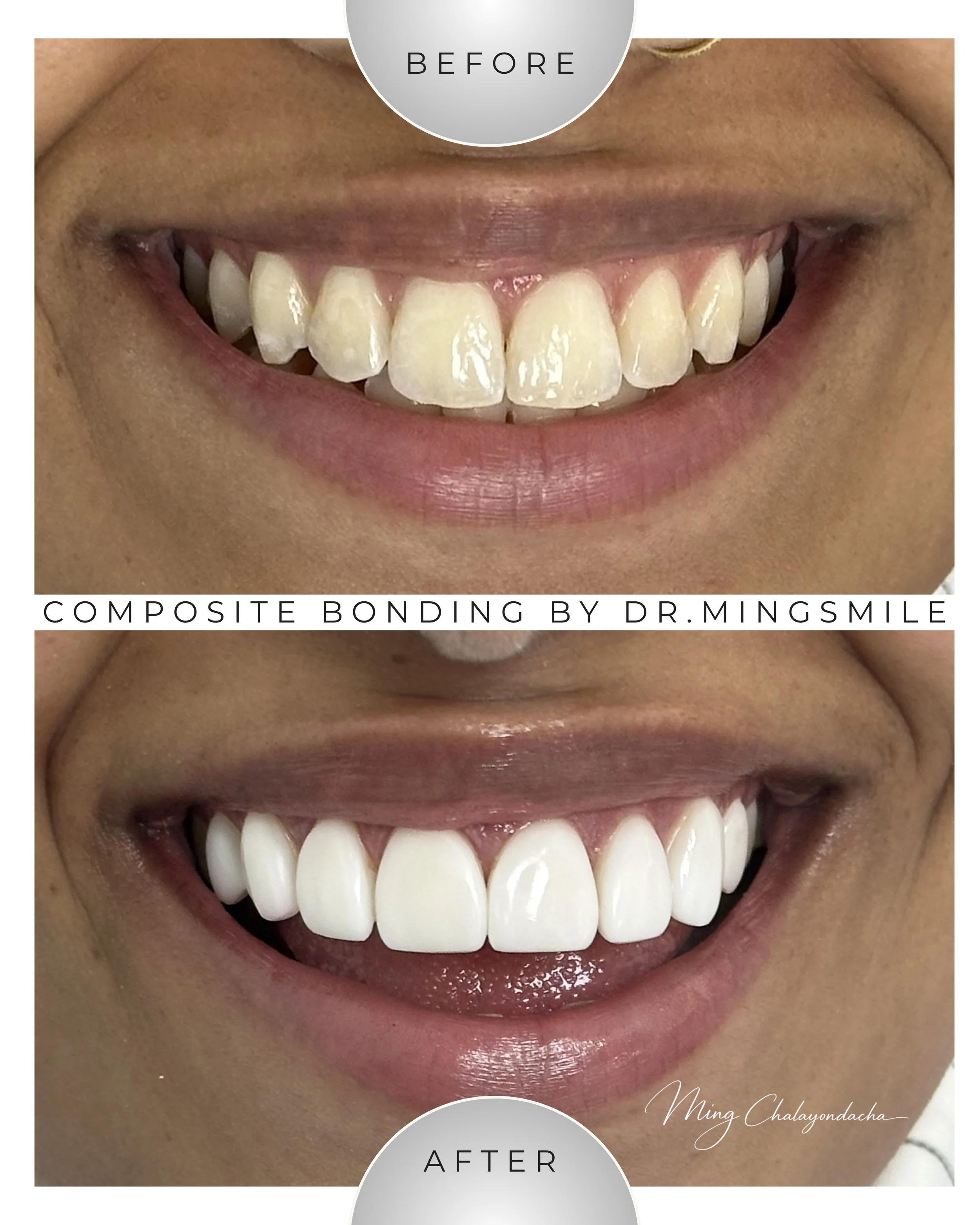 Close-up of a person's smile before and after dental composite bonding, showing improved, whiter, straighter teeth.