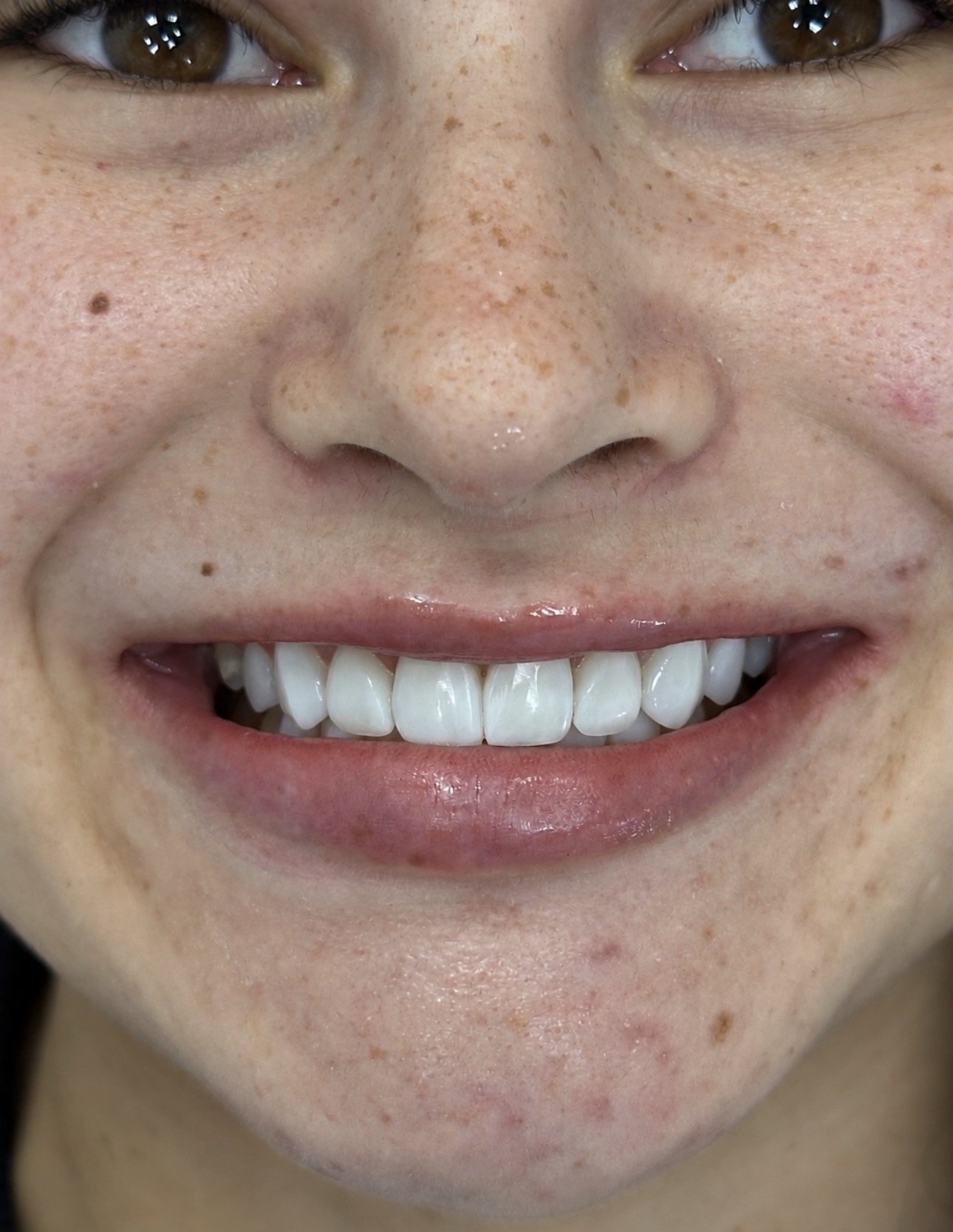 Close-up of a smiling person's face showing brown eyes, freckles, and white teeth.