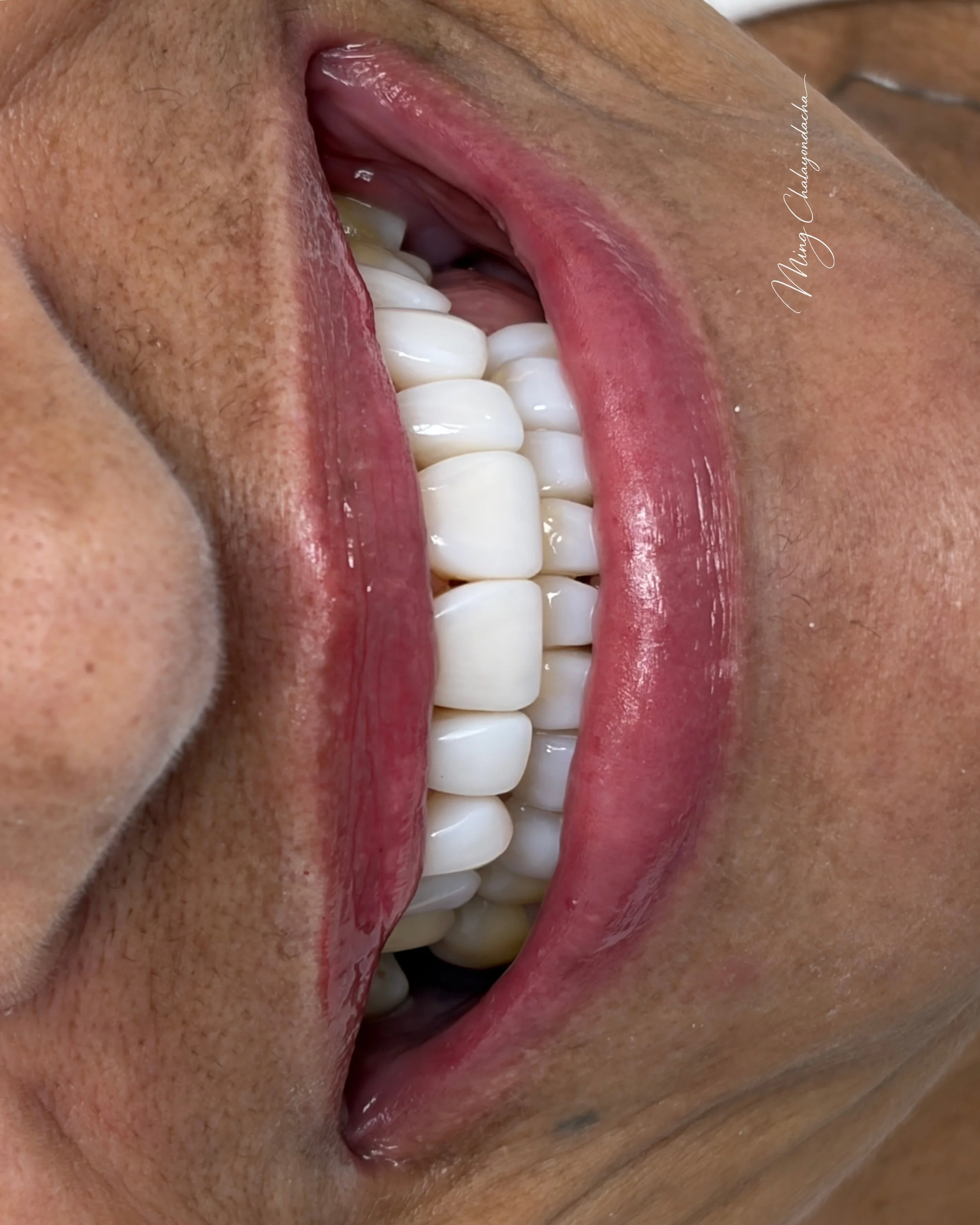 Close-up of a person's mouth open, showing upper and lower teeth and pink tongue inside.