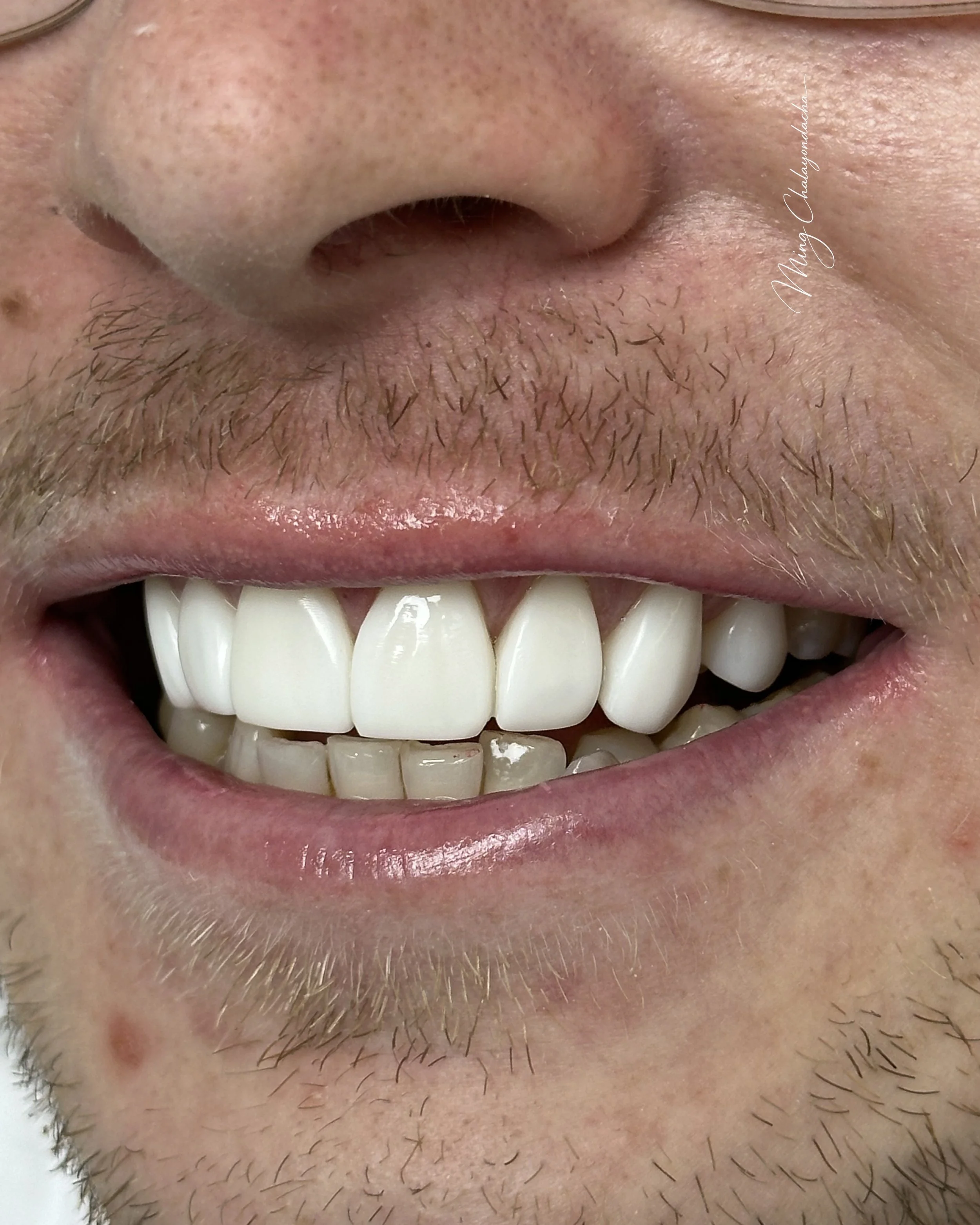 Close-up of a person's mouth smiling, showing white teeth and facial hair including a mustache and beard.