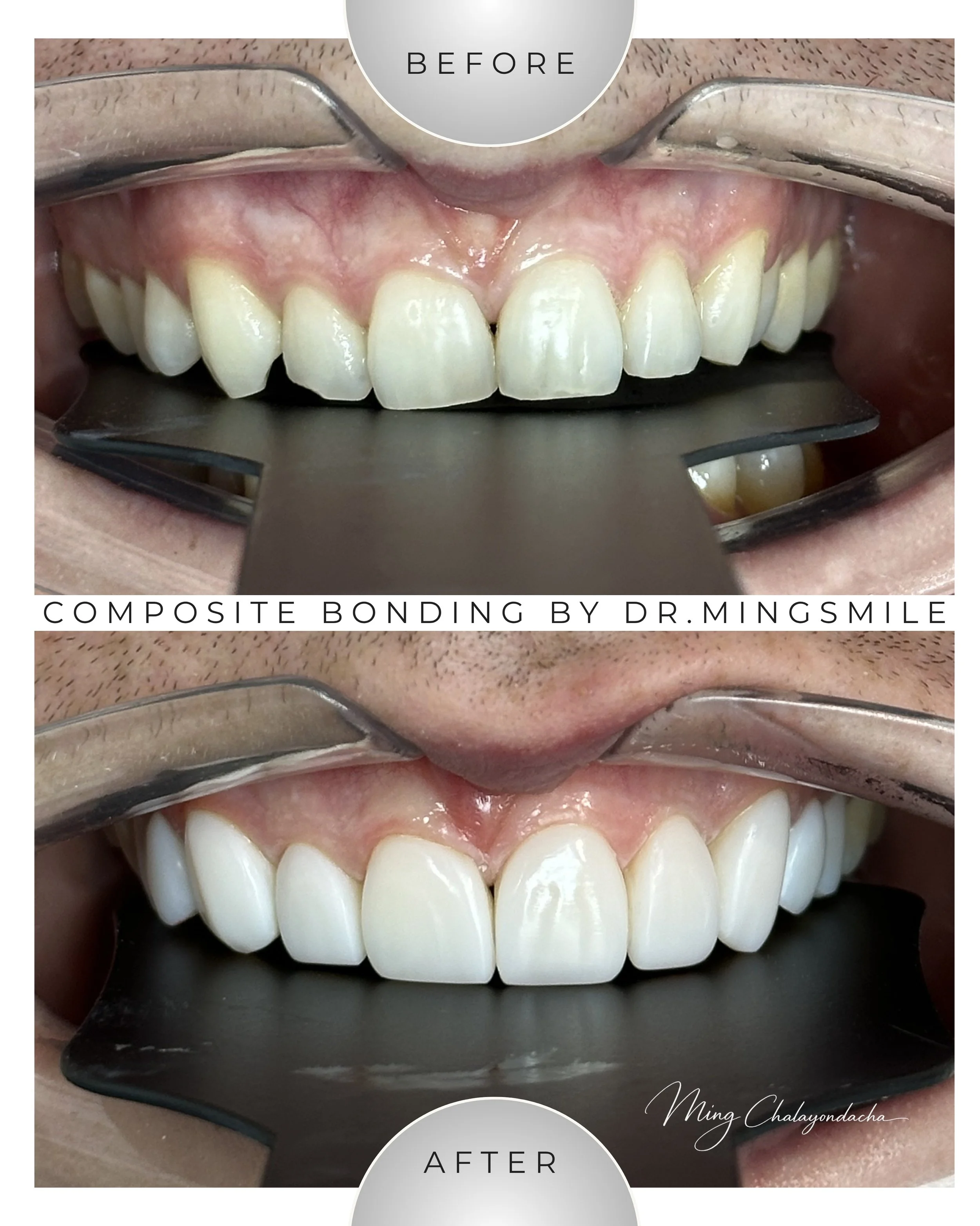 Close-up of teeth before and after composite bonding procedure, showing whiter, aligned teeth with dental tools in use.