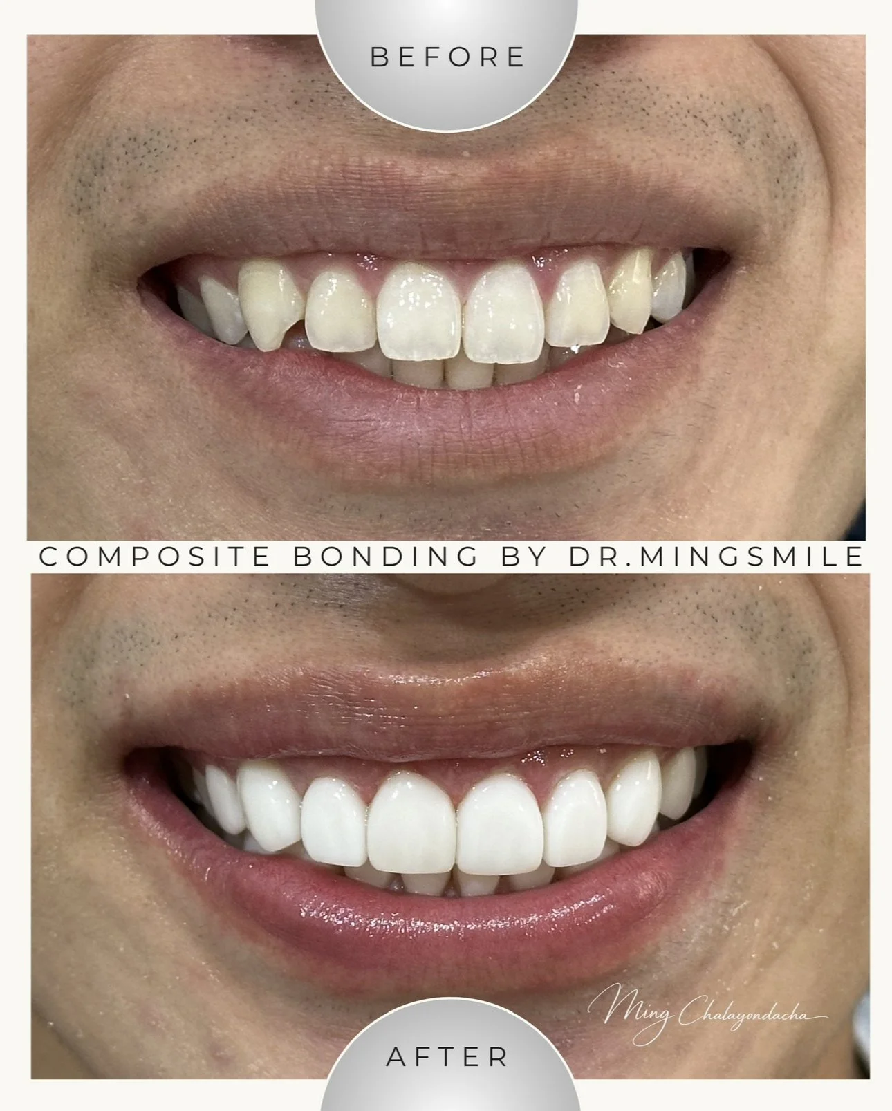 Before and after images of a person's smile demonstrating dental composite bonding by Dr. Mingsmile, showing improved teeth appearance.