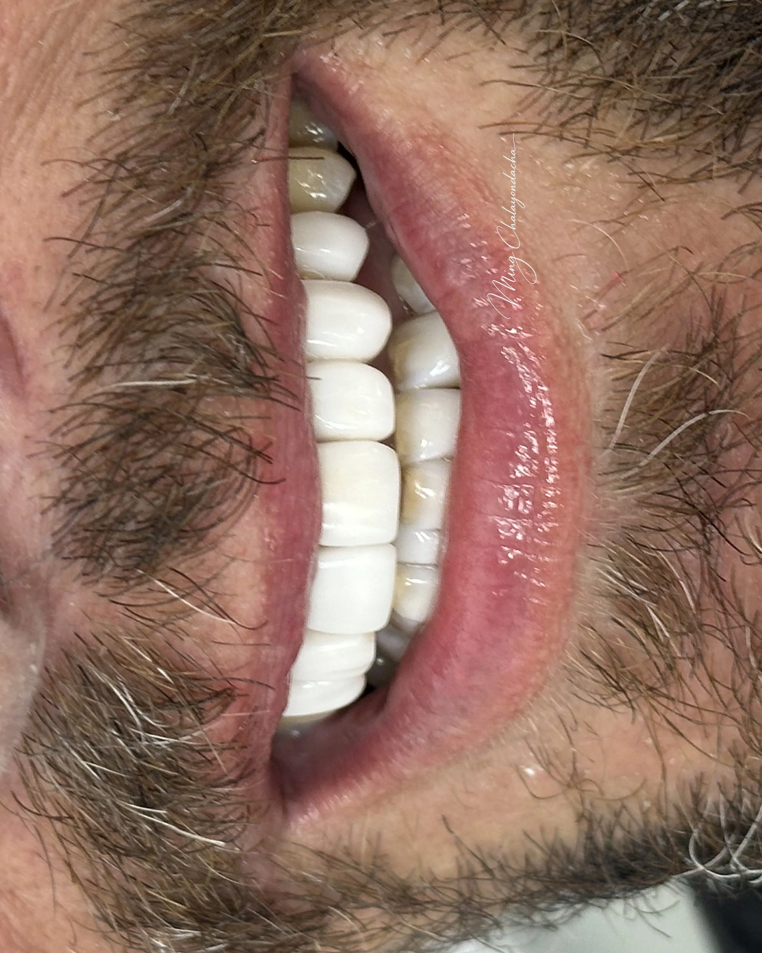 Close-up of a person's lower face with a beard, showing teeth and lips, with some teeth missing.