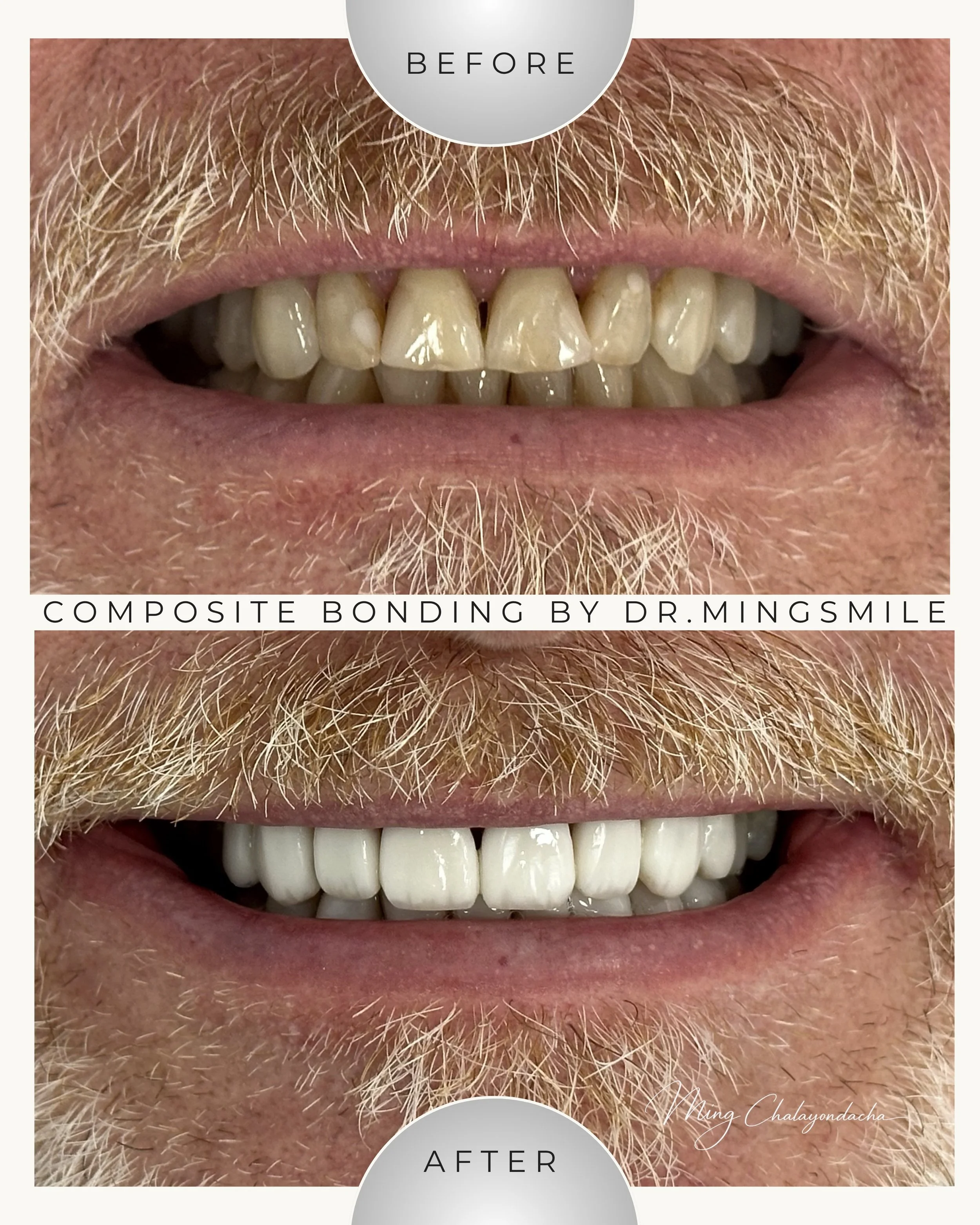 Close-up of a man's grinning mouth showing teeth before and after composite bonding by Dr. Mingsmile.