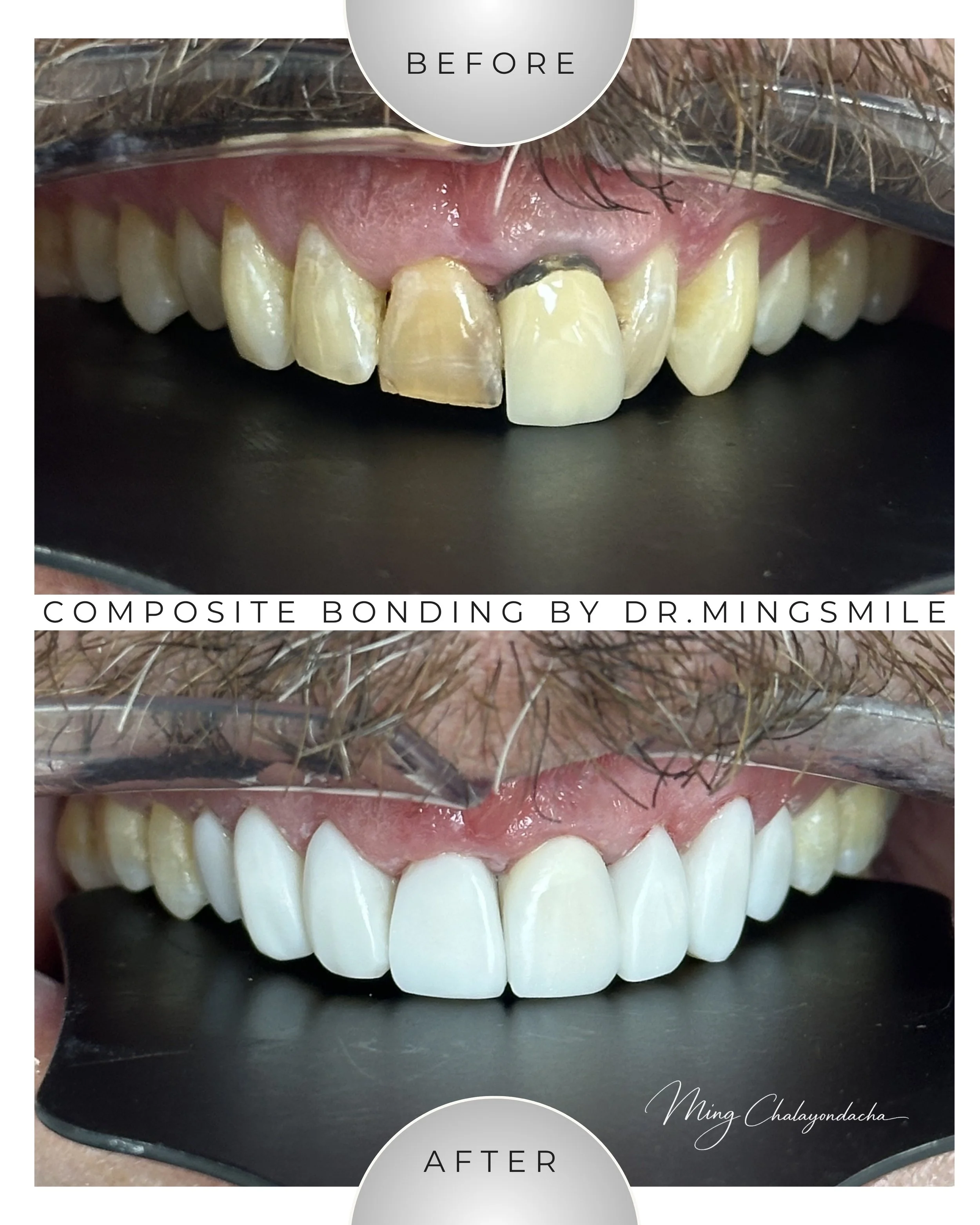 Close-up of a person's smile showing teeth before and after dental composite bonding treatment, with the before image on top and the after image at the bottom.