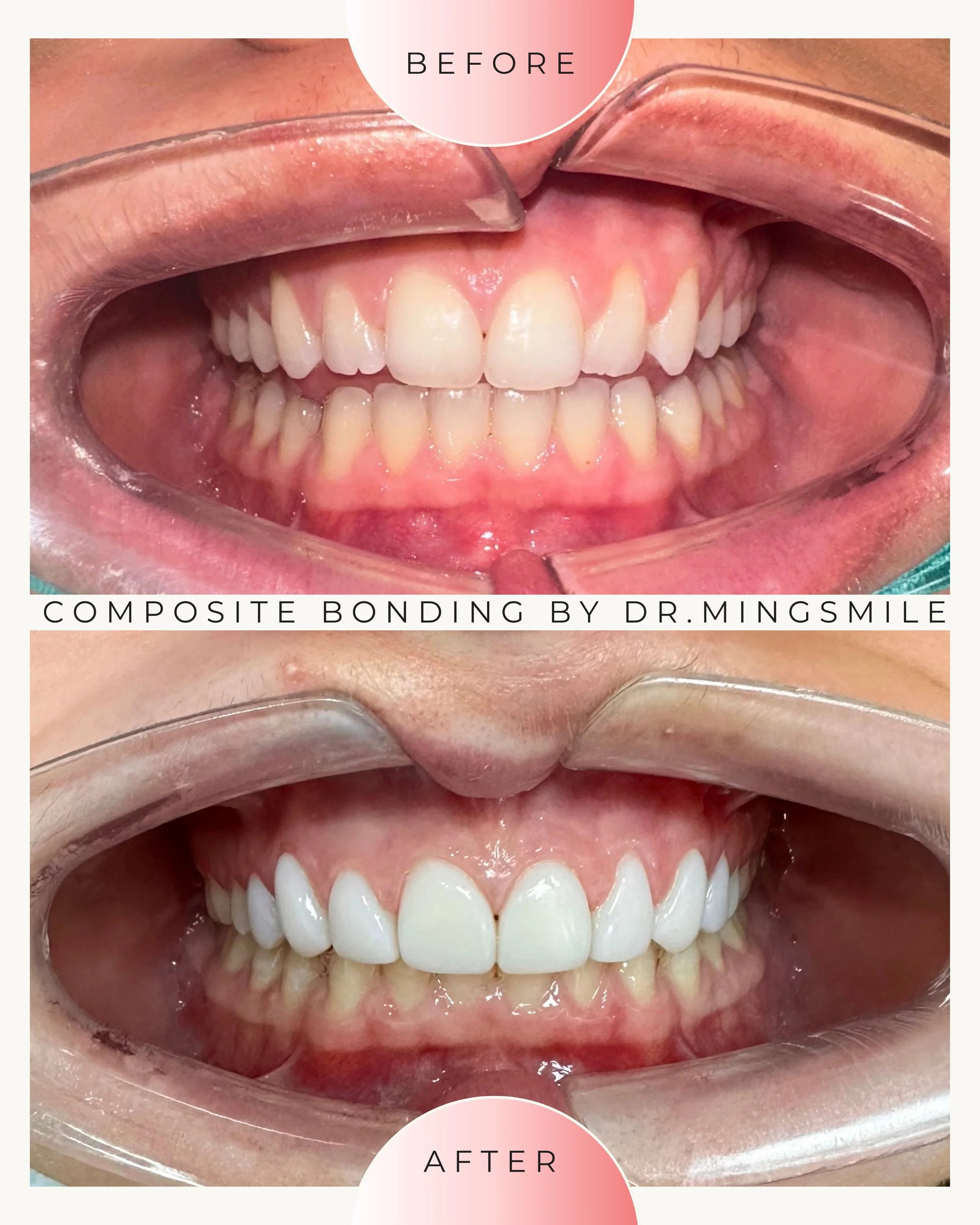 Close-up of a person's smile showing teeth before and after composite bonding, with the before image on top and the after image below, separated by labels.