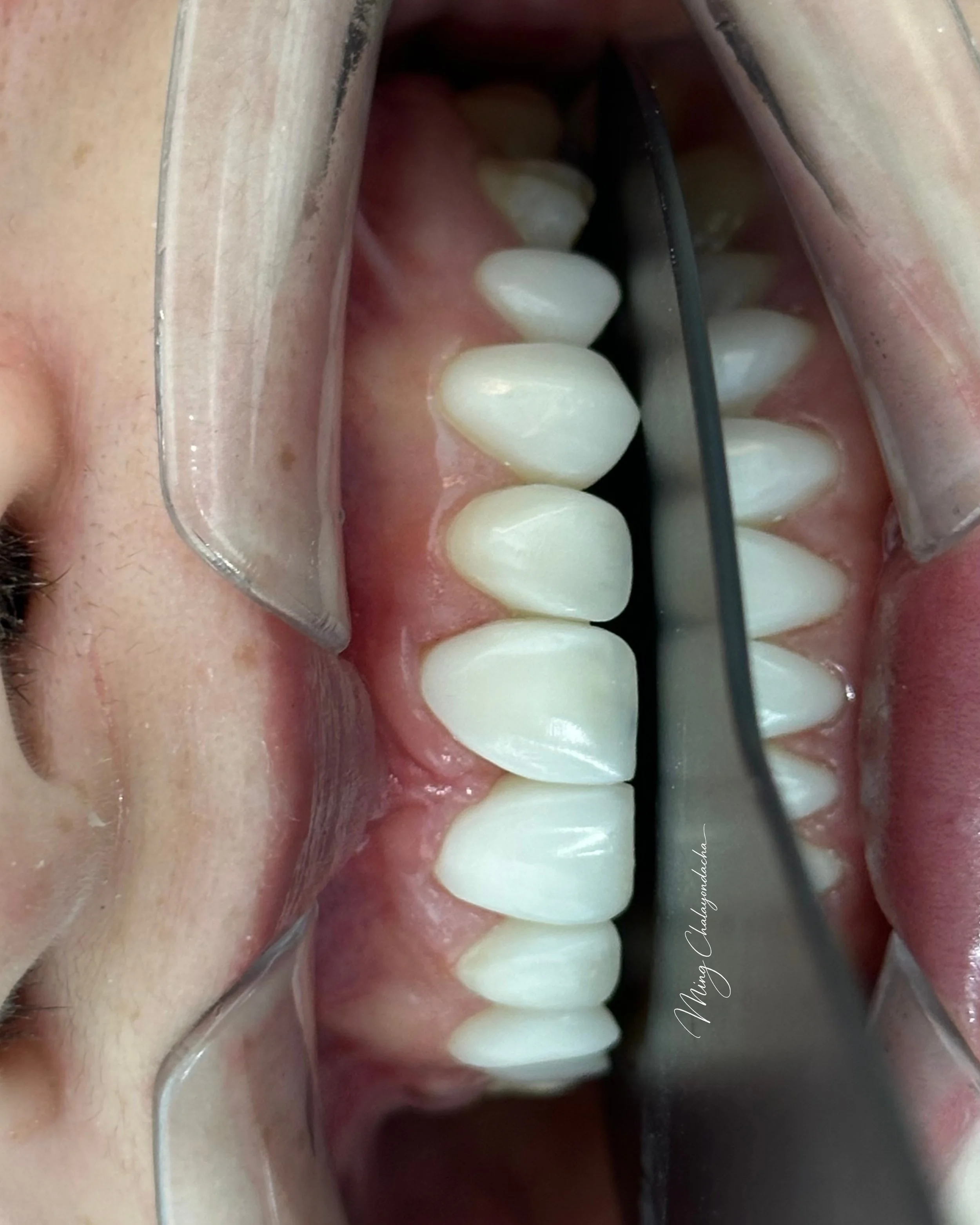 composite bonding 
