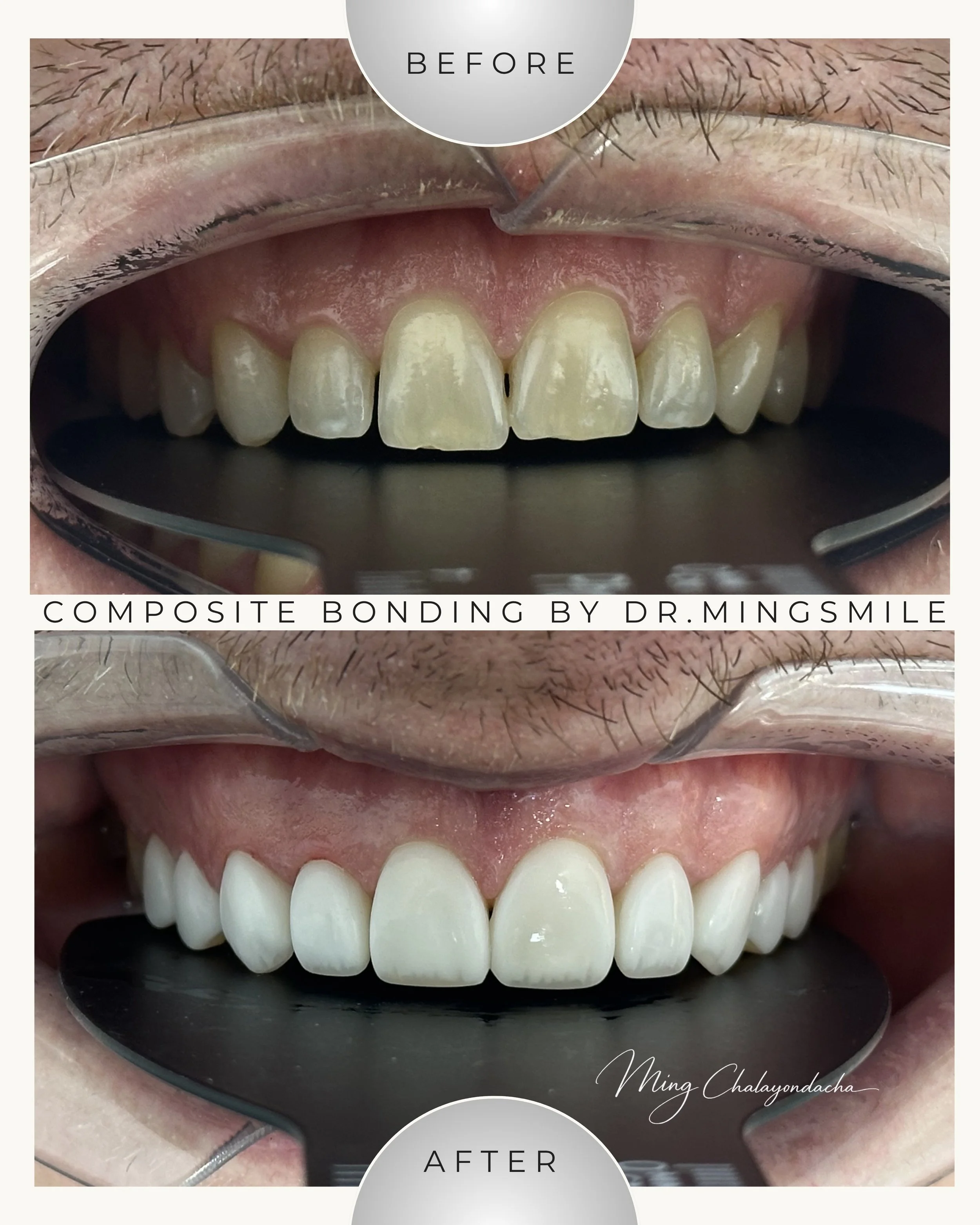 Close-up of a person's teeth before and after composite bonding, showing improved appearance in the after image.
