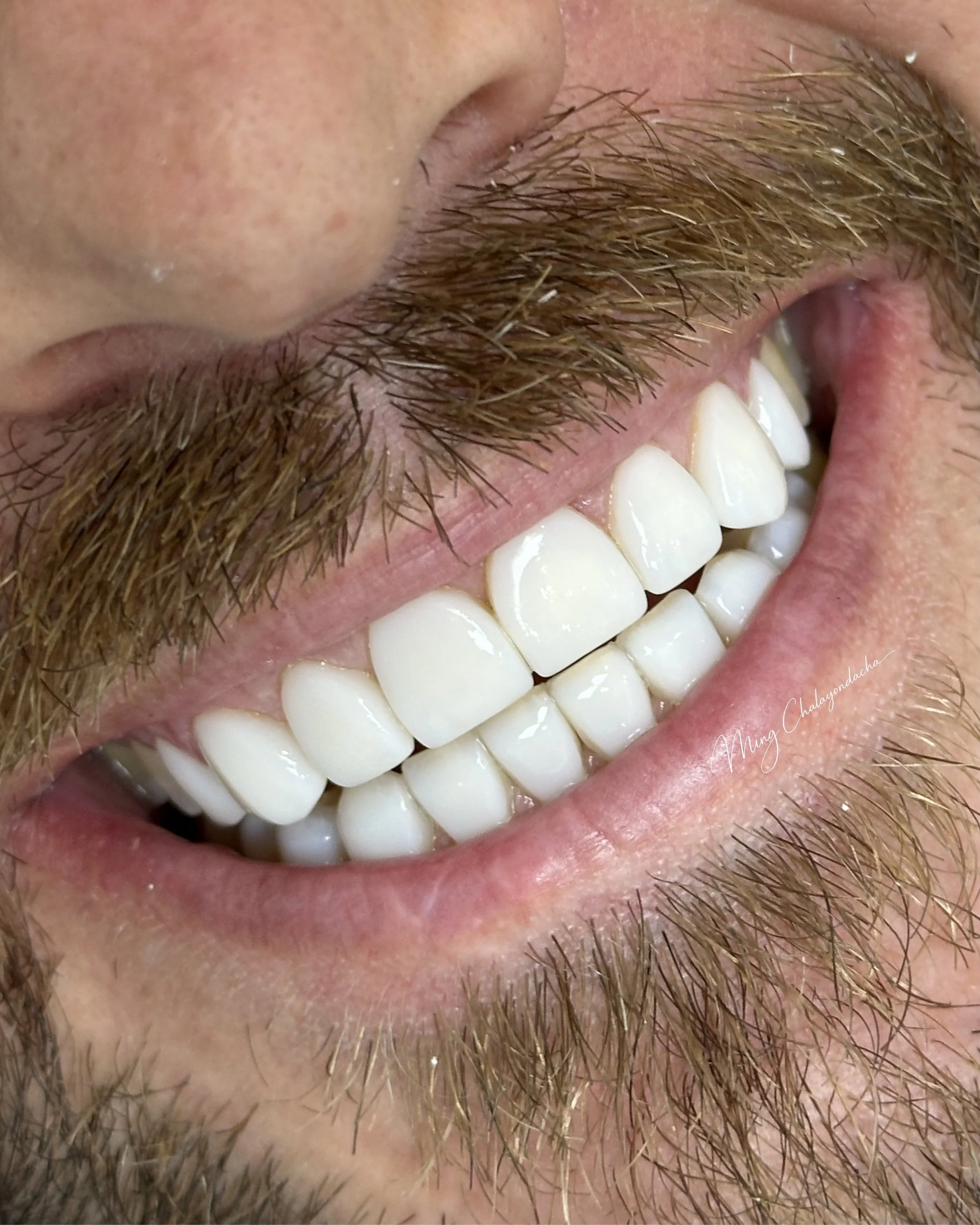 Close-up of a person's mouth showing white teeth, facial hair, and skin texture.