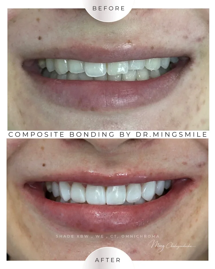 composite bonding transformation