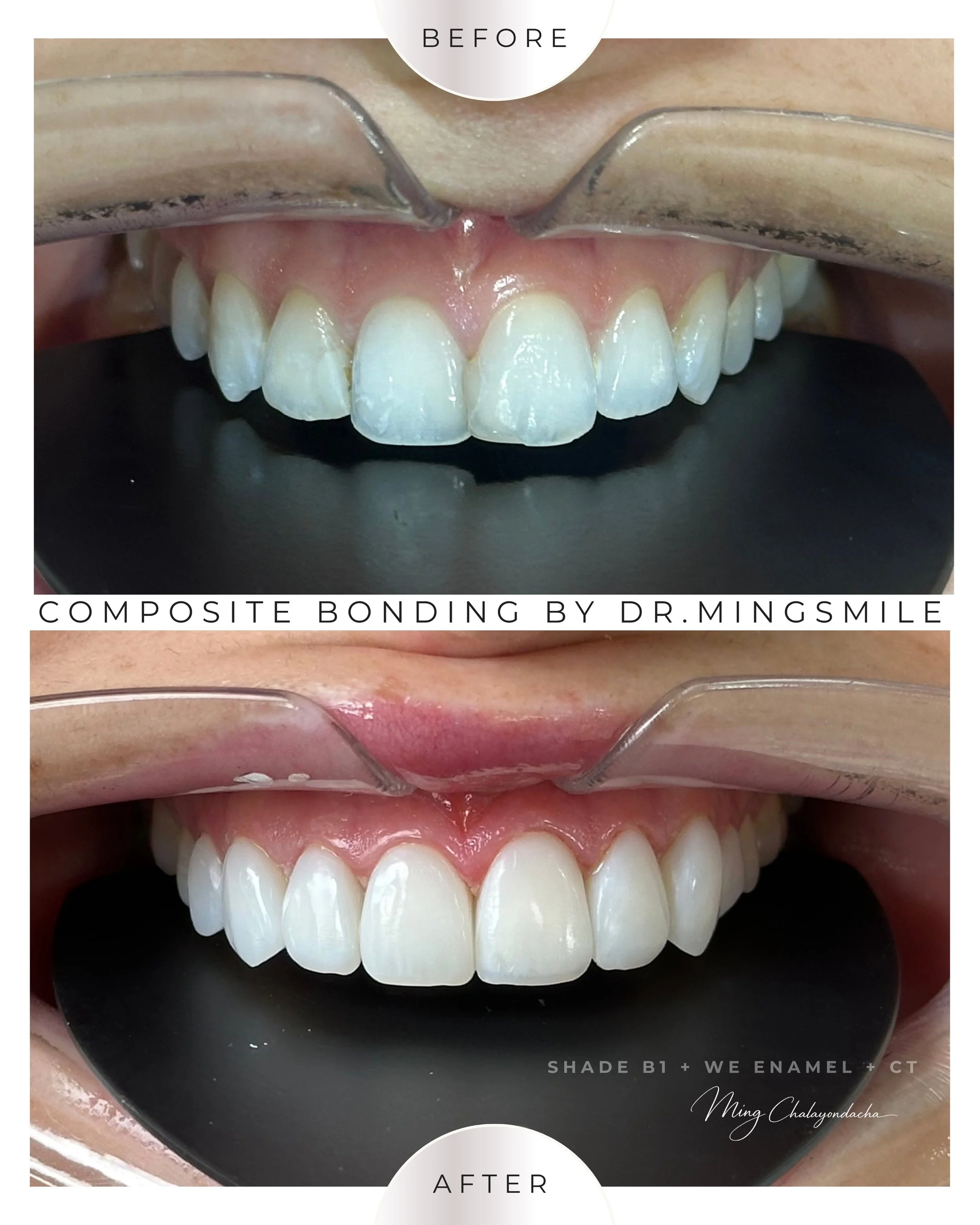 composite bonding  thailand bangkok krabi