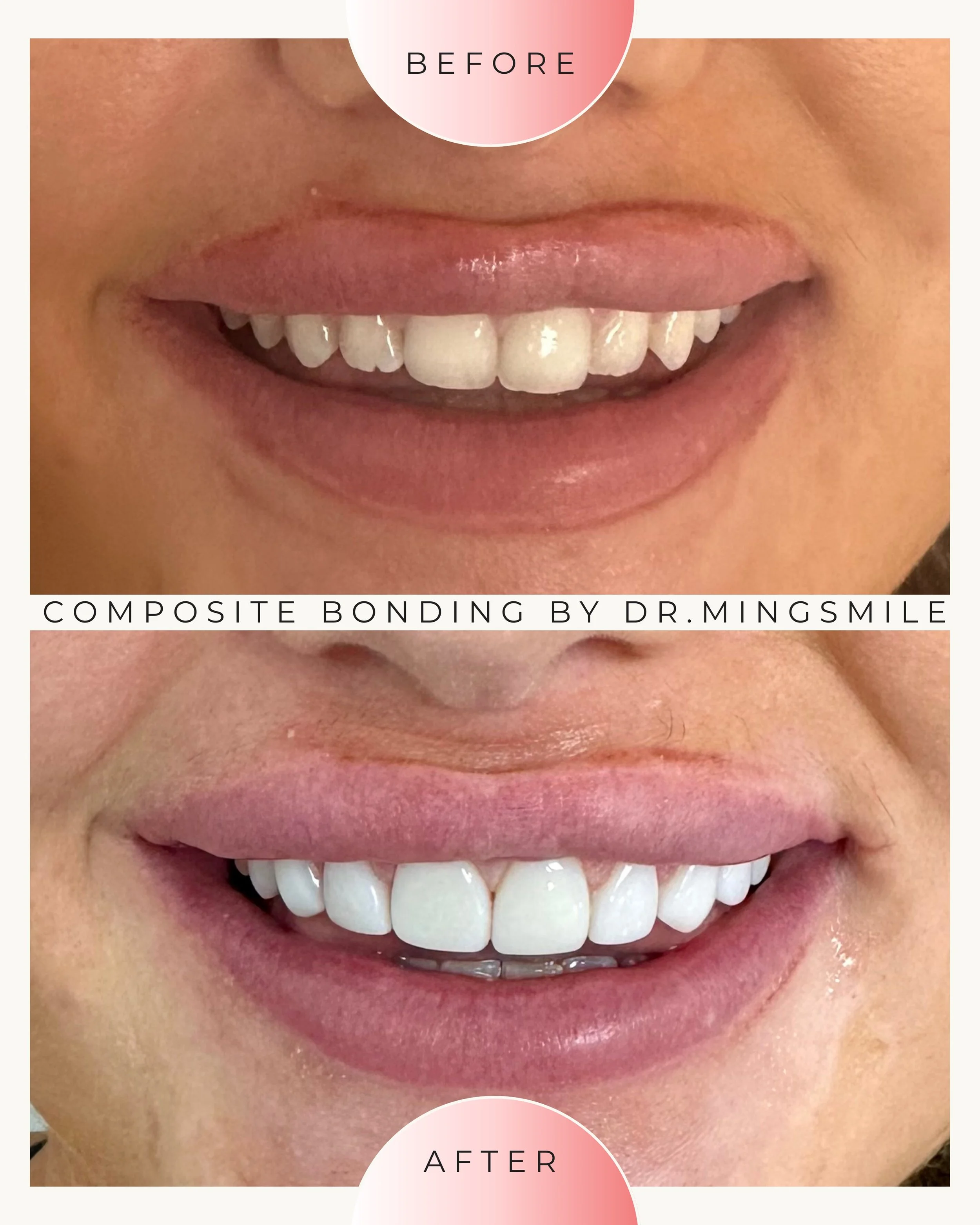 Close-up of a person's smiling mouth showing white, straight teeth in the after image, with a less bright smile in the before image above.
