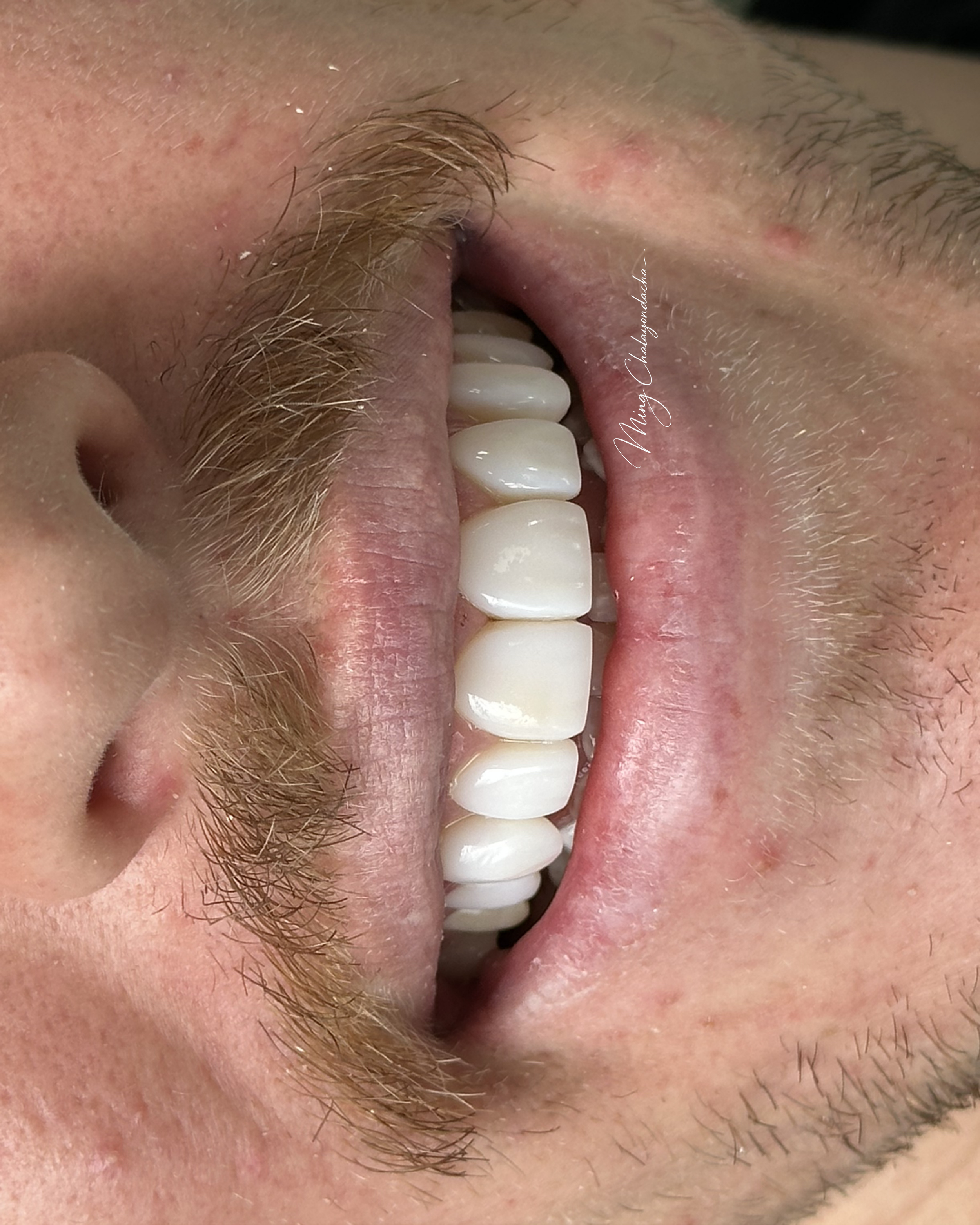 Close-up of a person's open mouth showing teeth, lips, and facial hair, with some skin redness around the lips.
