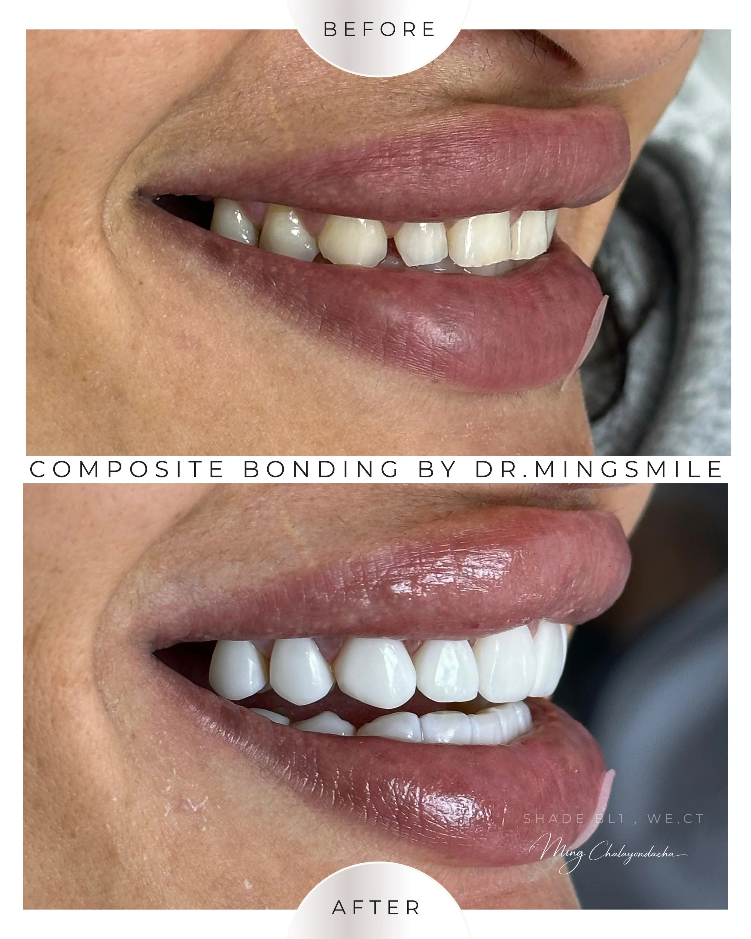 Close-up of a person's smile showing white, straight teeth before and after composite bonding.