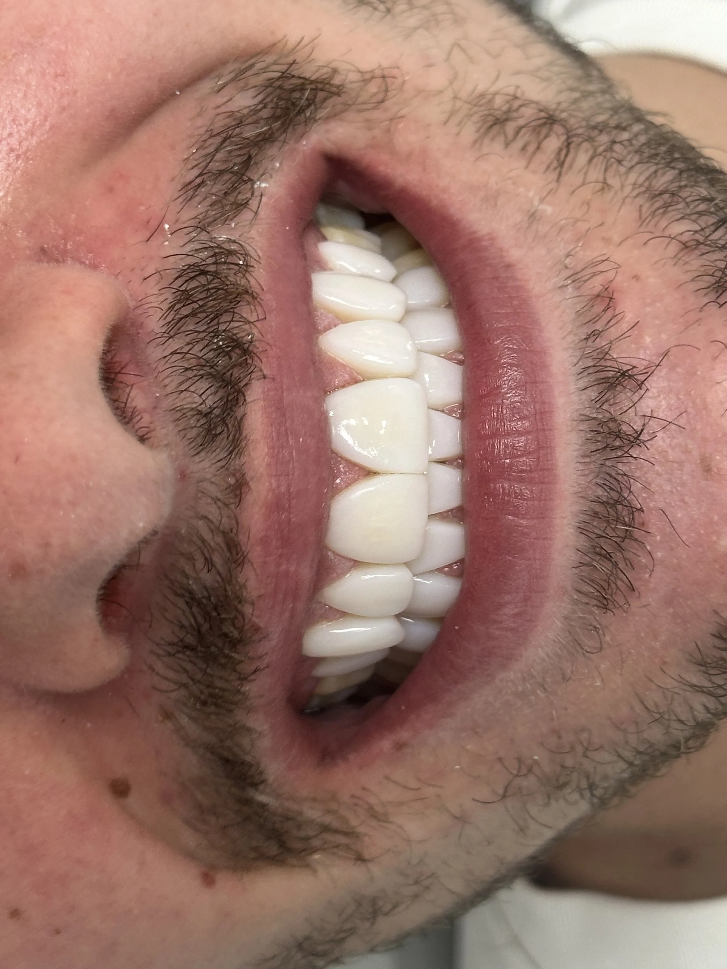 Close-up of a person's open mouth showing white teeth, lips, facial hair, and a small mole on the chin.