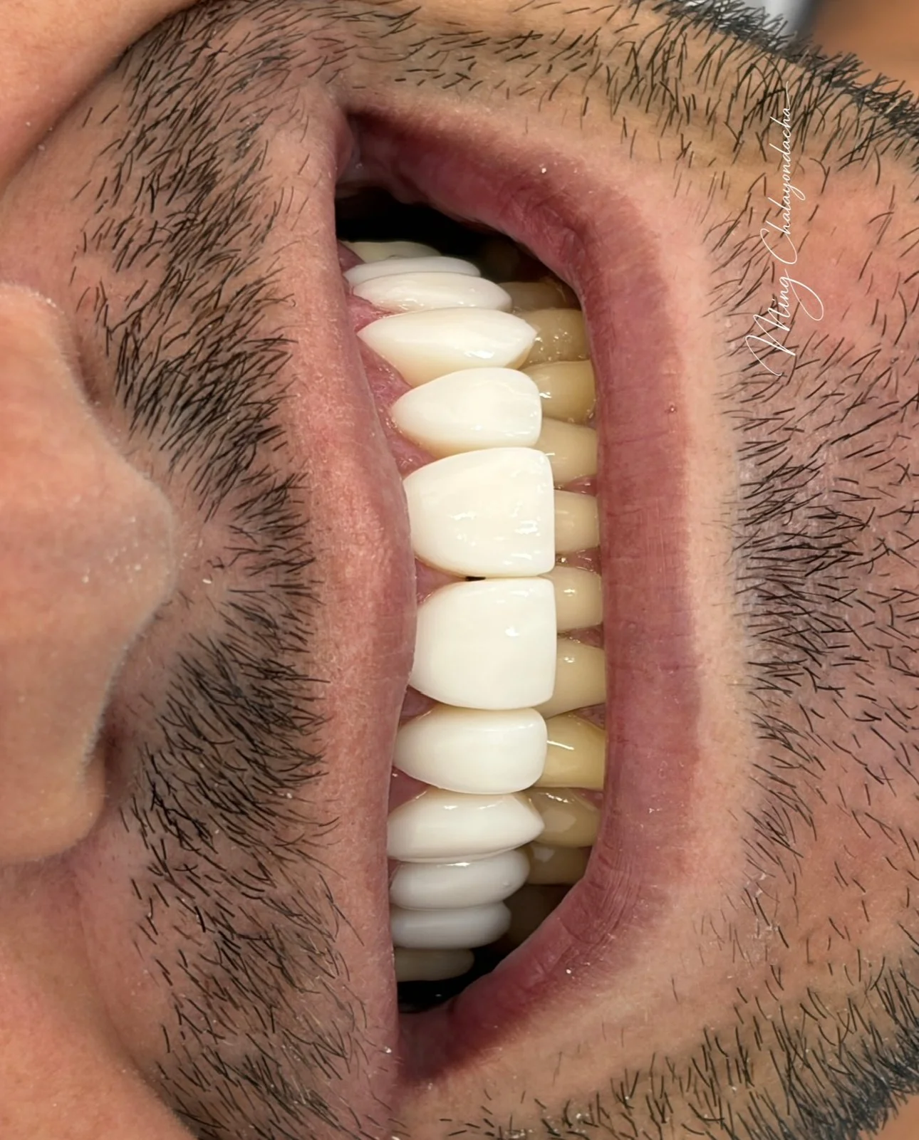 Close-up of a person's open mouth showing teeth and gums, with facial hair around the mouth.
