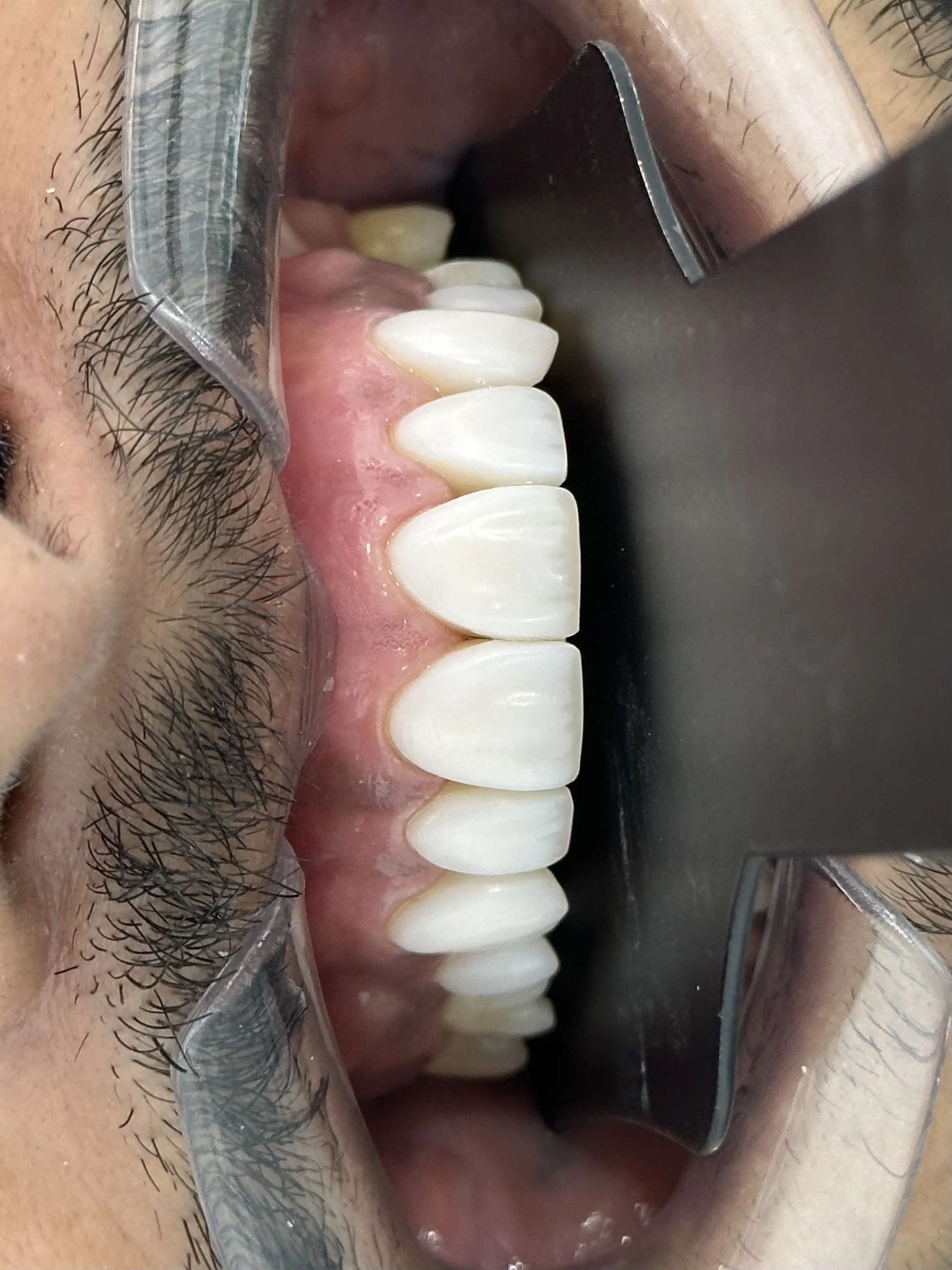 Close-up of a person's mouth with teeth and pink gums, wearing dental cheek retractors.