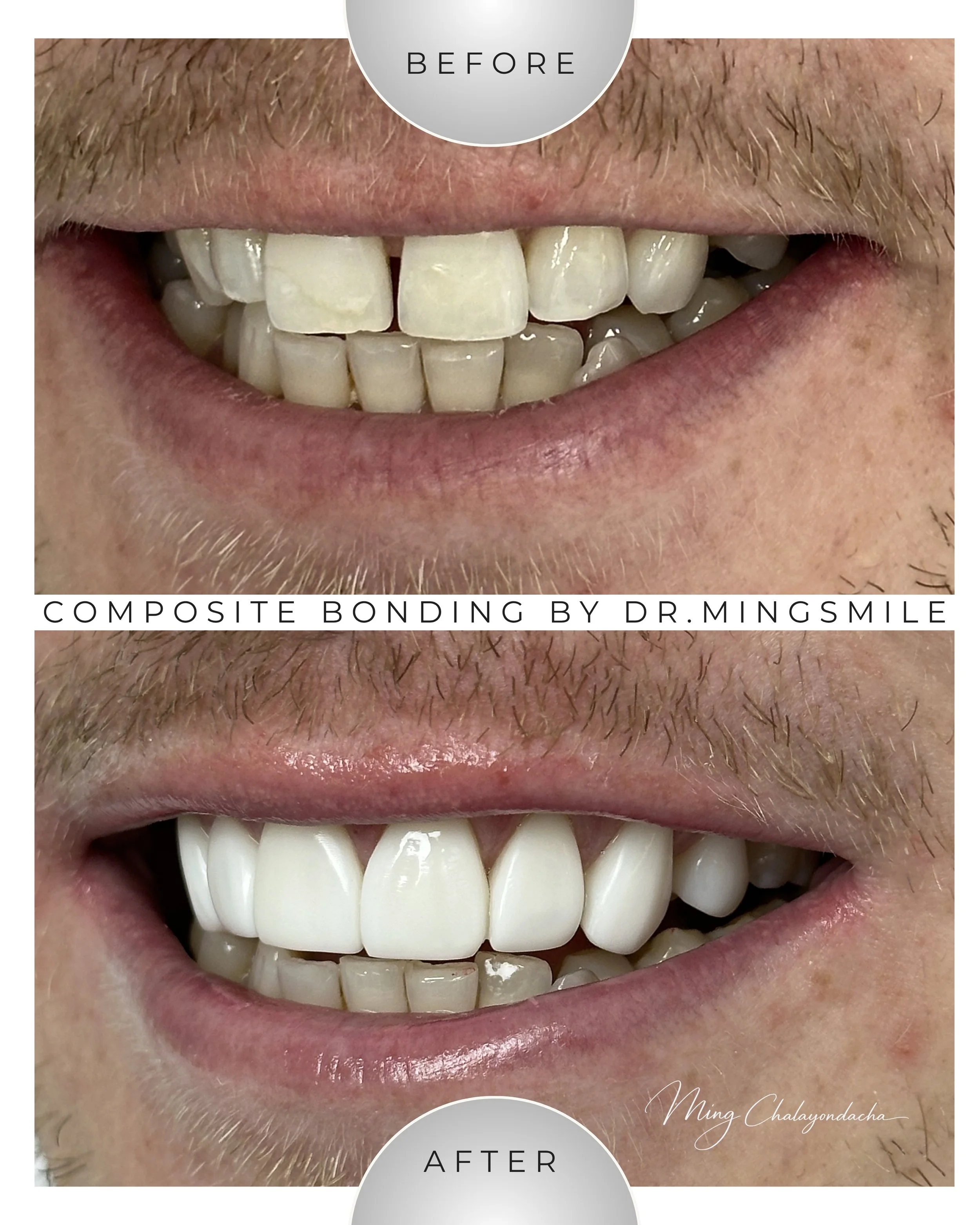 Close-up of a person's smiling mouth showing teeth before and after composite bonding procedure, with the top showing the 'Before' and the bottom showing the 'After'.