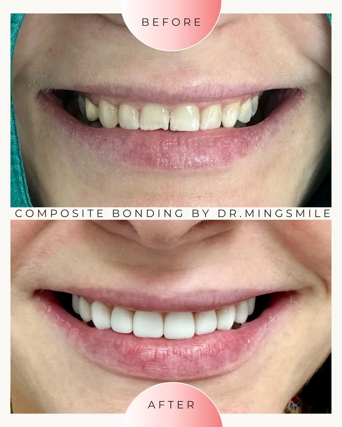 Before-and-after photos showing a person's smile, highlighting composite dental bonding by Dr. Mingsmile. The before image shows teeth with gaps and unevenness, while the after image shows a set of straight, white teeth.