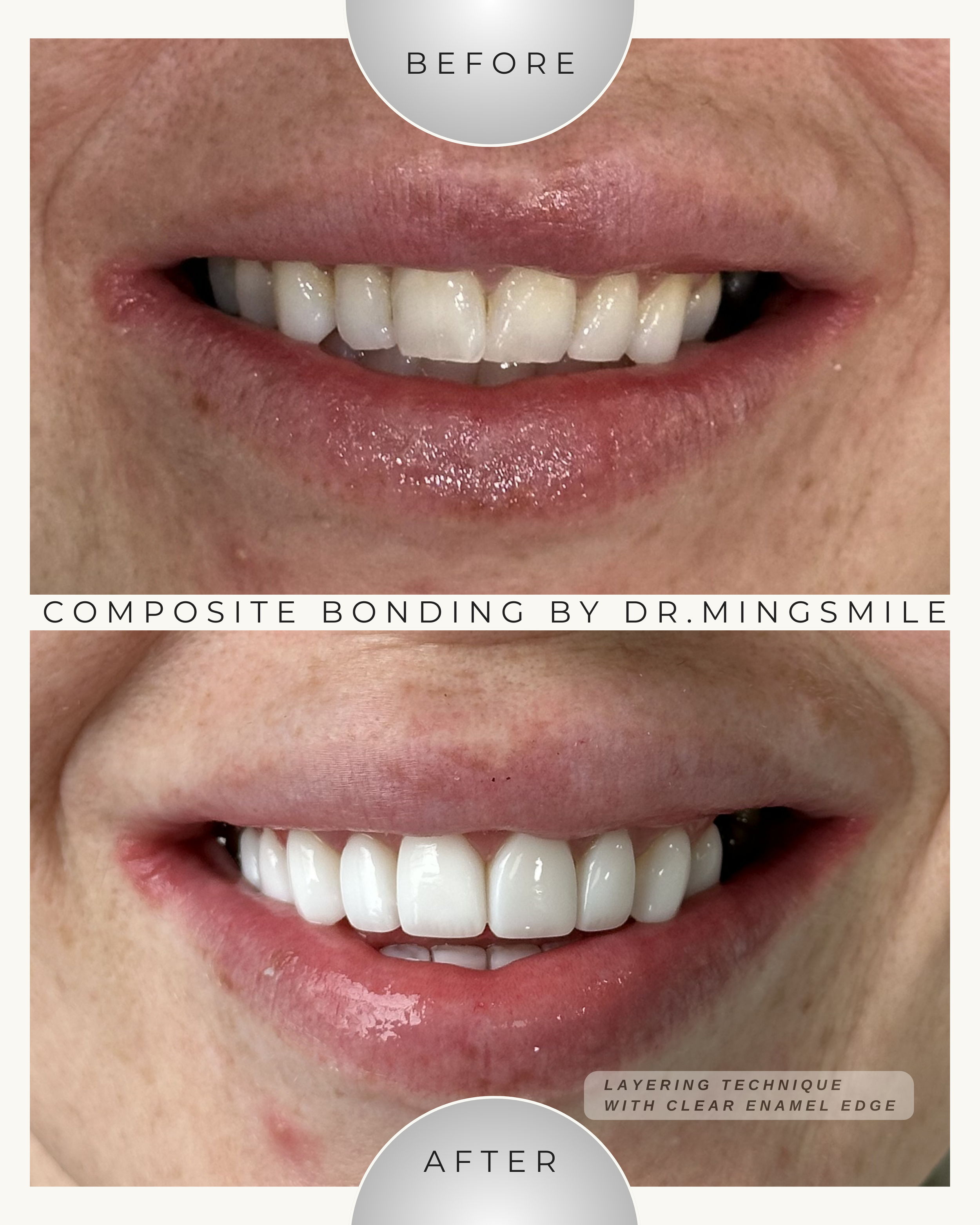 Close-up of a person's smile showing white, evenly aligned teeth before and after dental composite bonding with clear enamel edges, taken by Dr. Mingsmile.