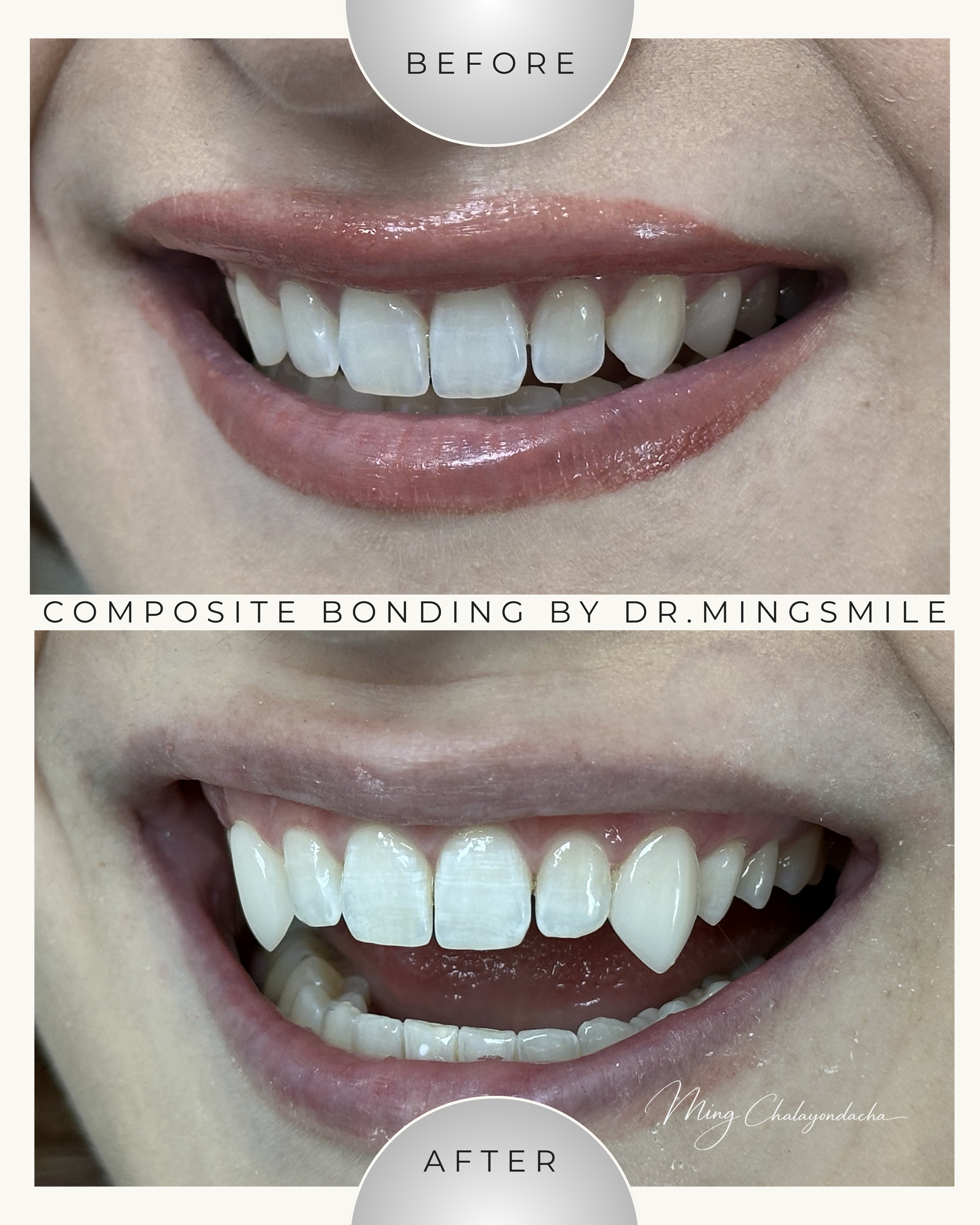 Close-up of a person's smile showing before and after results of composite bonding dental procedure, with healthy white teeth and pink gums.