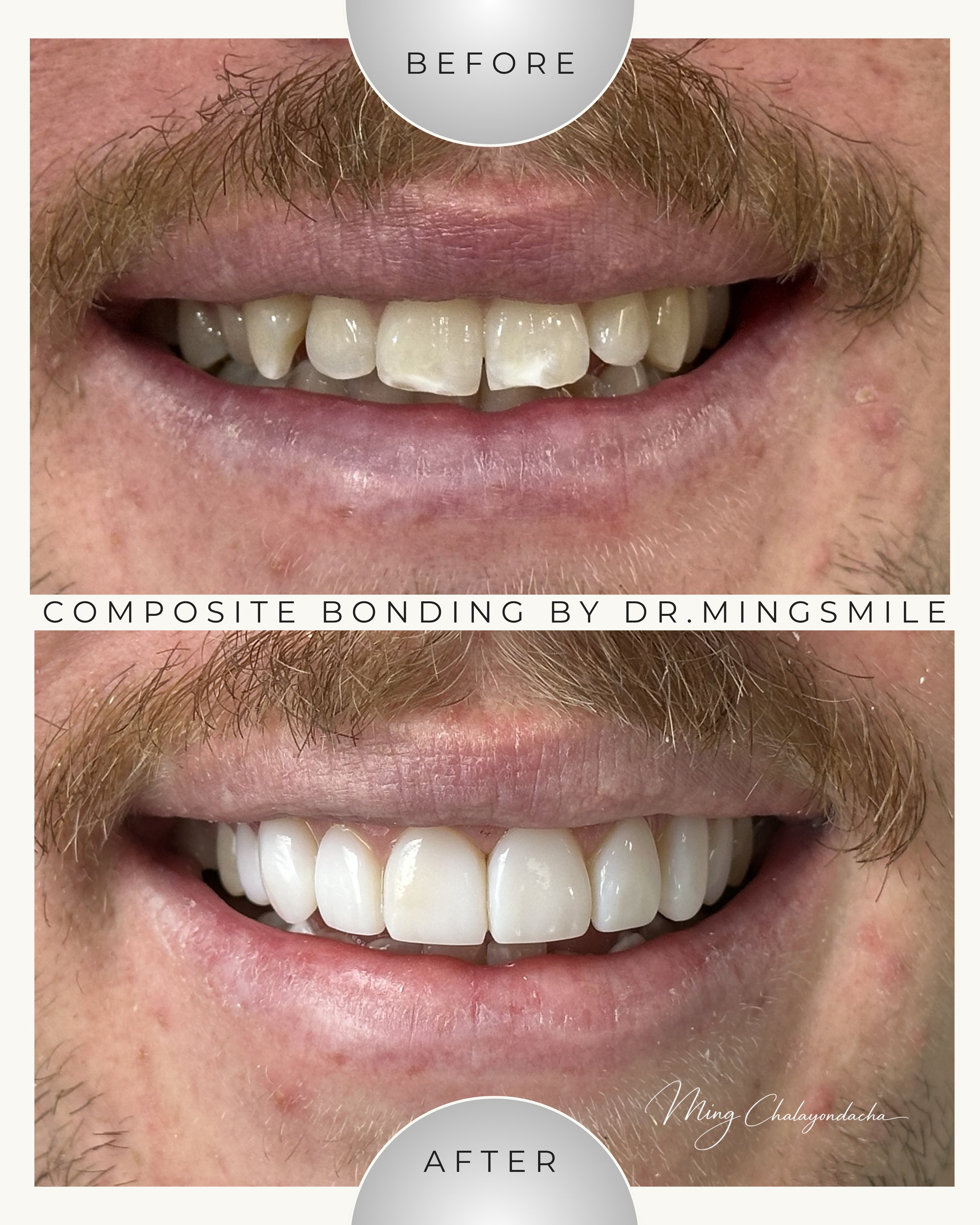 Close-up of a person's smile showing before and after composite bonding of teeth, with the top showing teeth with imperfections and the bottom showing the restored, whiter teeth.