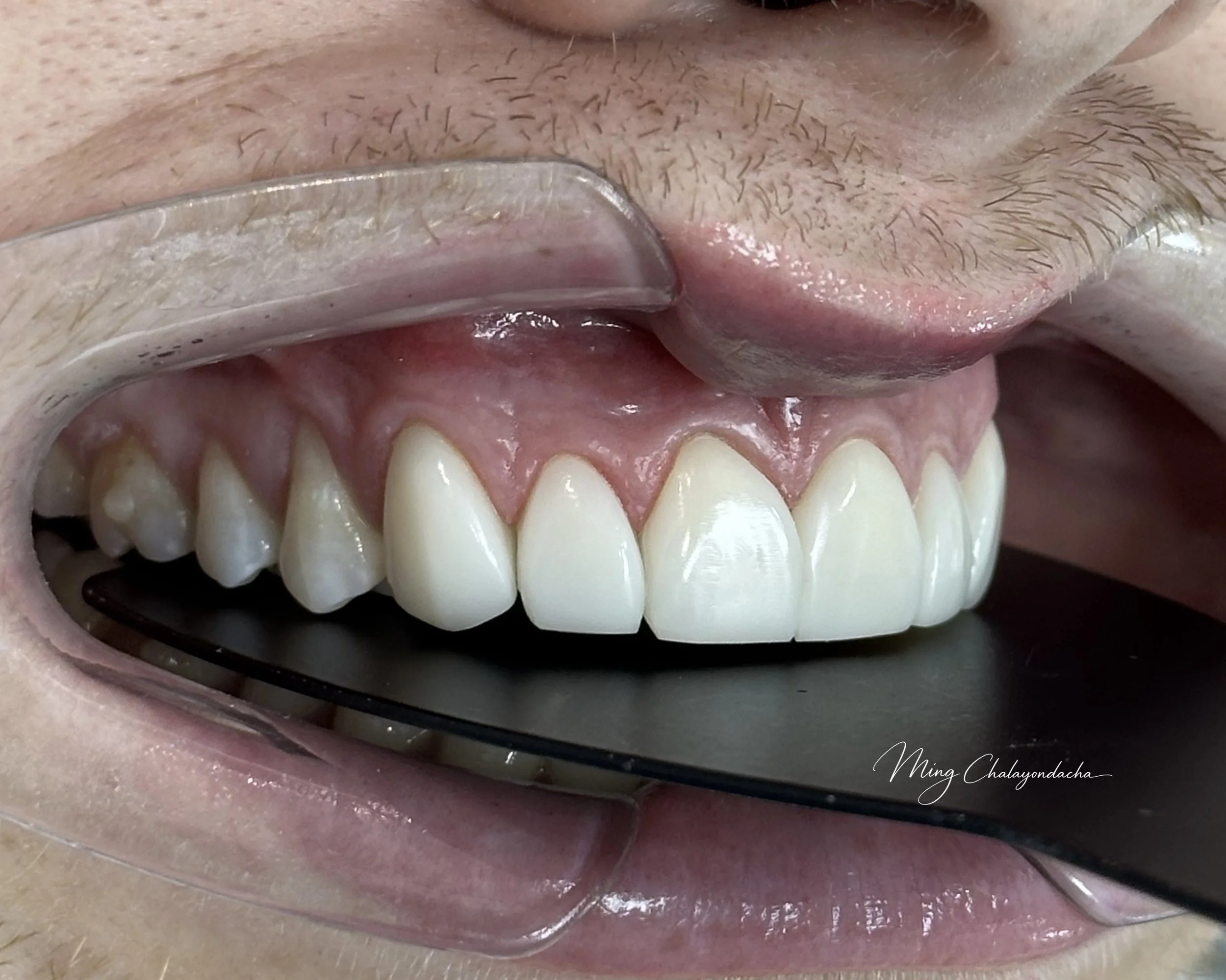 Close-up of a person's open mouth with teeth visible, a dental mirror showing inside, and a dental tool.