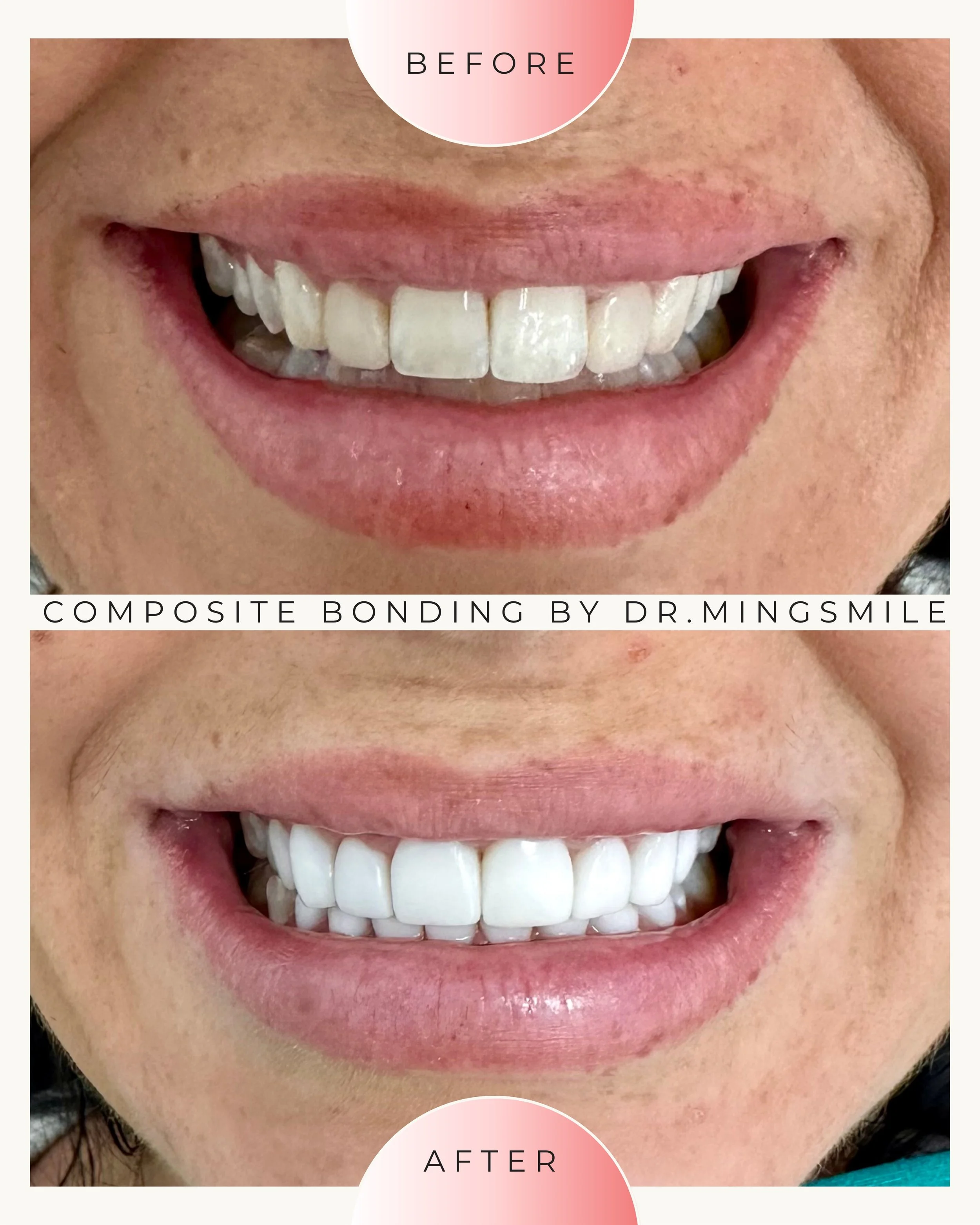 Close-up of a person's smiling mouth showing before and after dental composite bonding, with the 'before' on top and the 'after' on bottom, performed by Dr. Mingsmile.