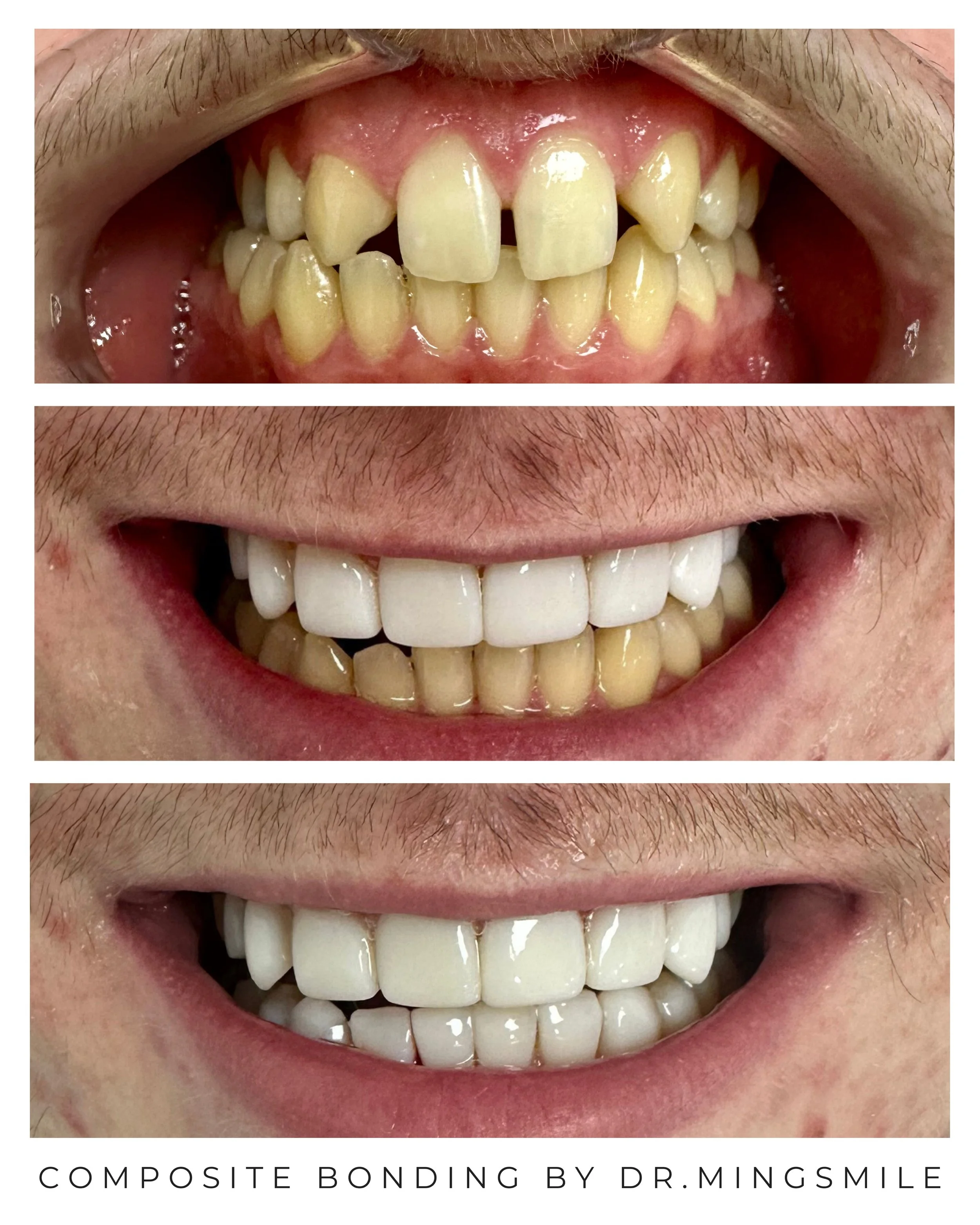 Comparison of teeth before and after composite bonding treatment performed by Dr. Mingsmile.