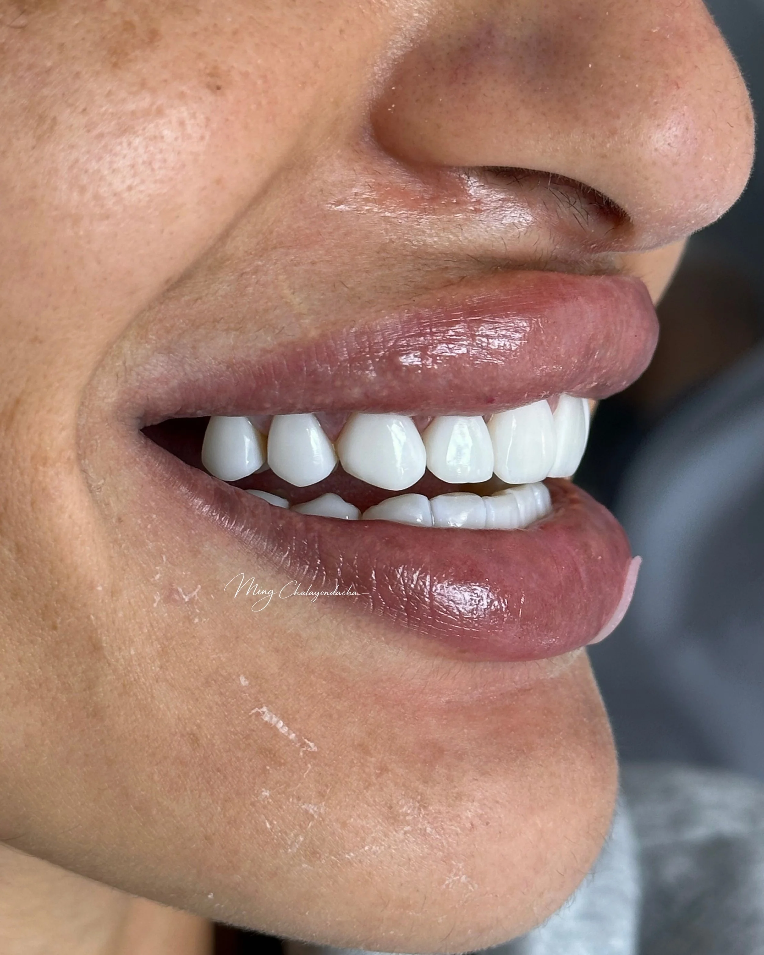 Close-up of a person's smiling mouth showing white teeth and full lips, with a portion of the nose visible.